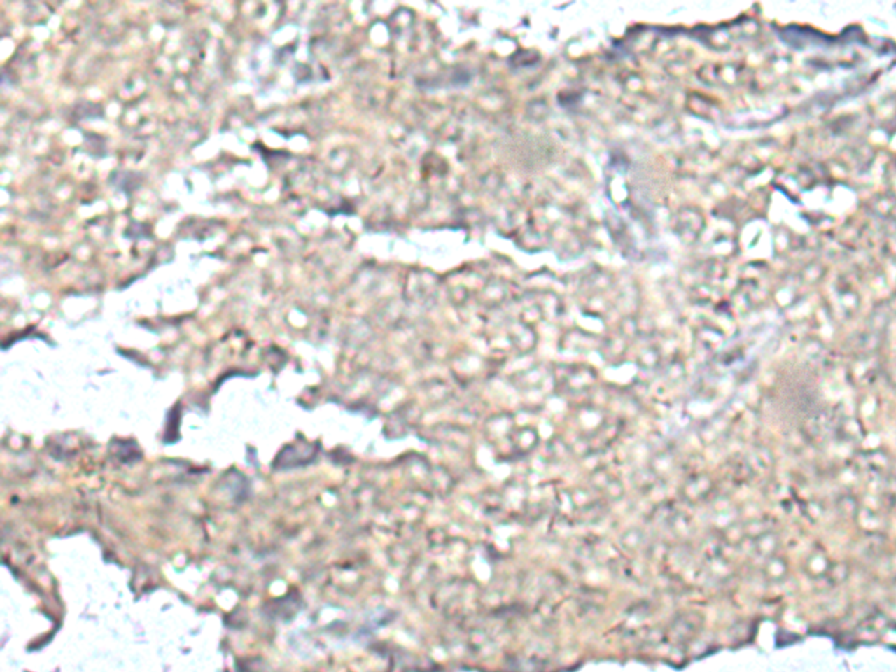 Immunohistochemistry of paraffin-embedded Human ovarian cancer tissue  using MEF2D Polyclonal Antibody at dilution of 1:50(×200)