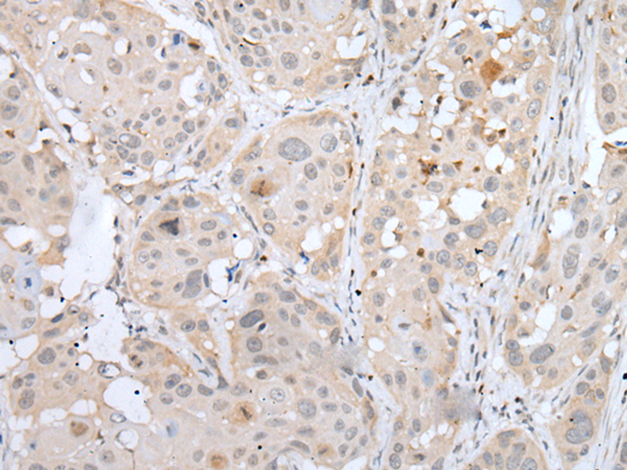 Immunohistochemistry of paraffin-embedded Human esophagus cancer tissue  using BORCS8 Polyclonal Antibody at dilution of 1:50(×200)