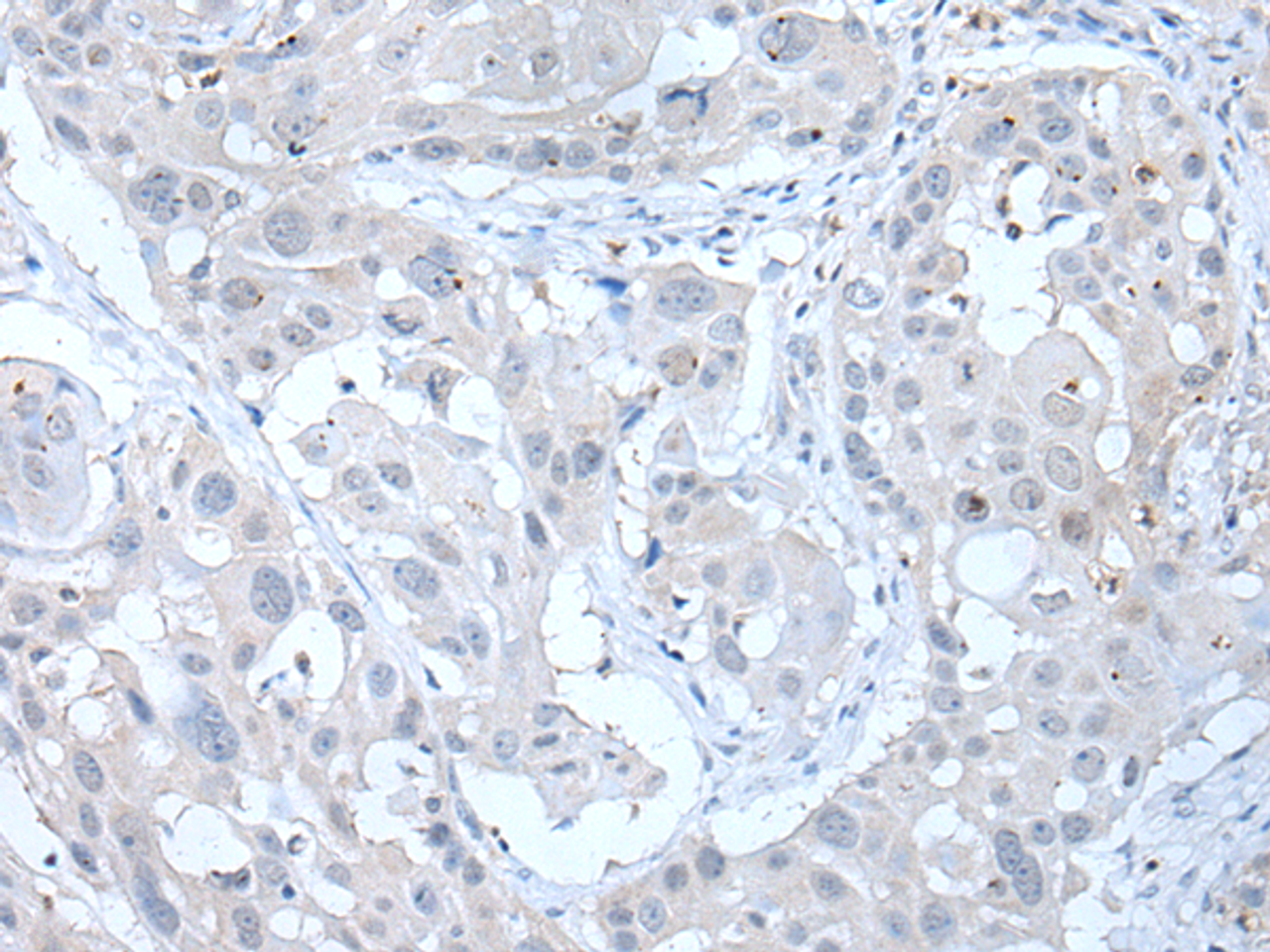 Immunohistochemistry of paraffin-embedded Human esophagus cancer tissue  using ANGPTL6 Polyclonal Antibody at dilution of 1:55(×200)