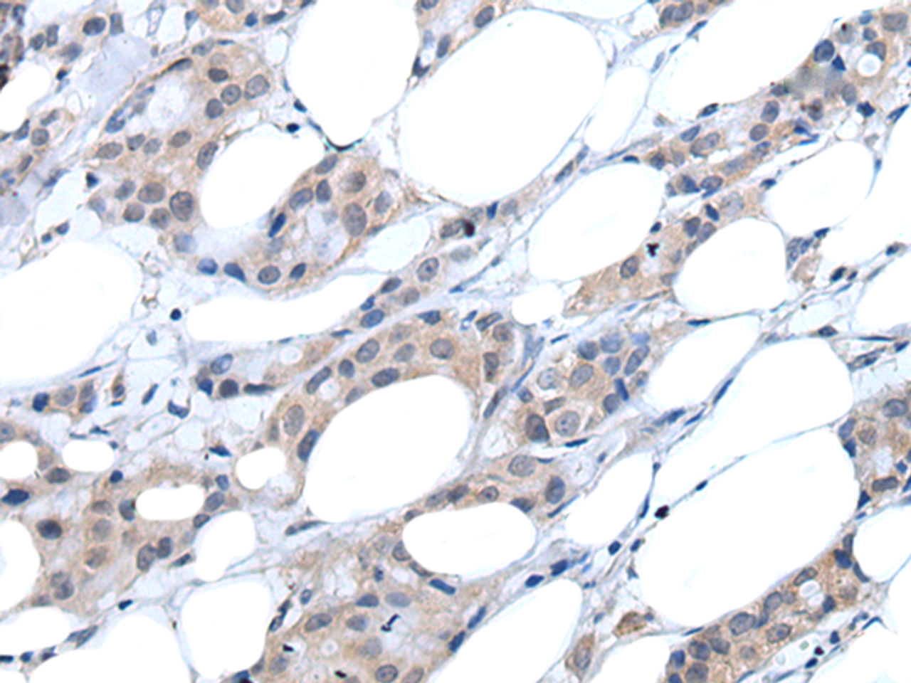 Immunohistochemistry of paraffin-embedded Human breast cancer tissue  using ANGPTL6 Polyclonal Antibody at dilution of 1:55(×200)