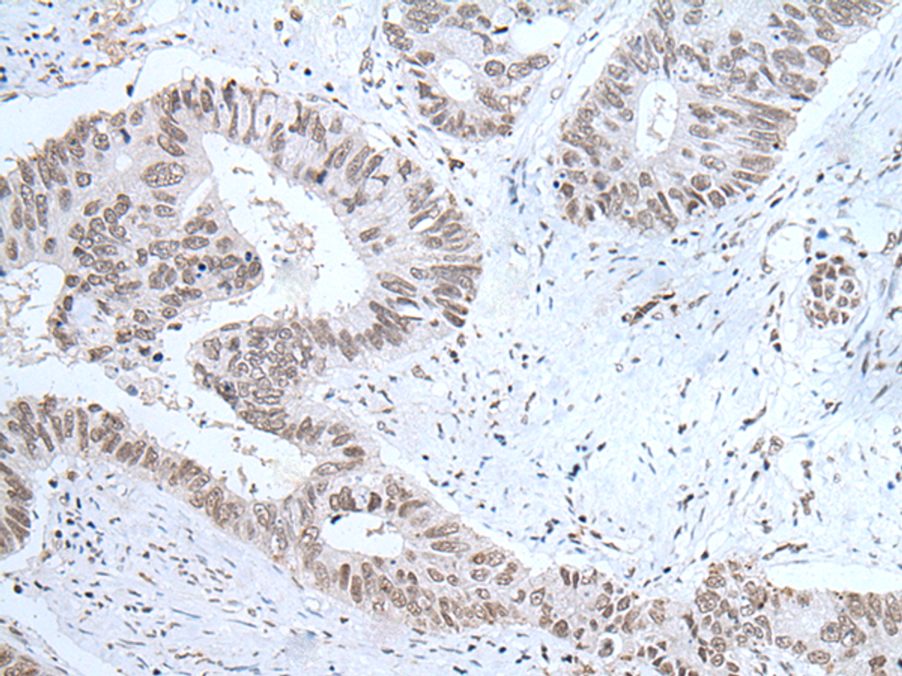 Immunohistochemistry of paraffin-embedded Human colorectal cancer tissue  using HCRT Polyclonal Antibody at dilution of 1:25(×200)