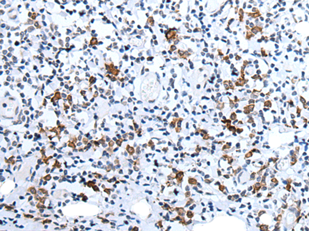 Immunohistochemistry of paraffin-embedded Human tonsil tissue  using HCRT Polyclonal Antibody at dilution of 1:25(×200)