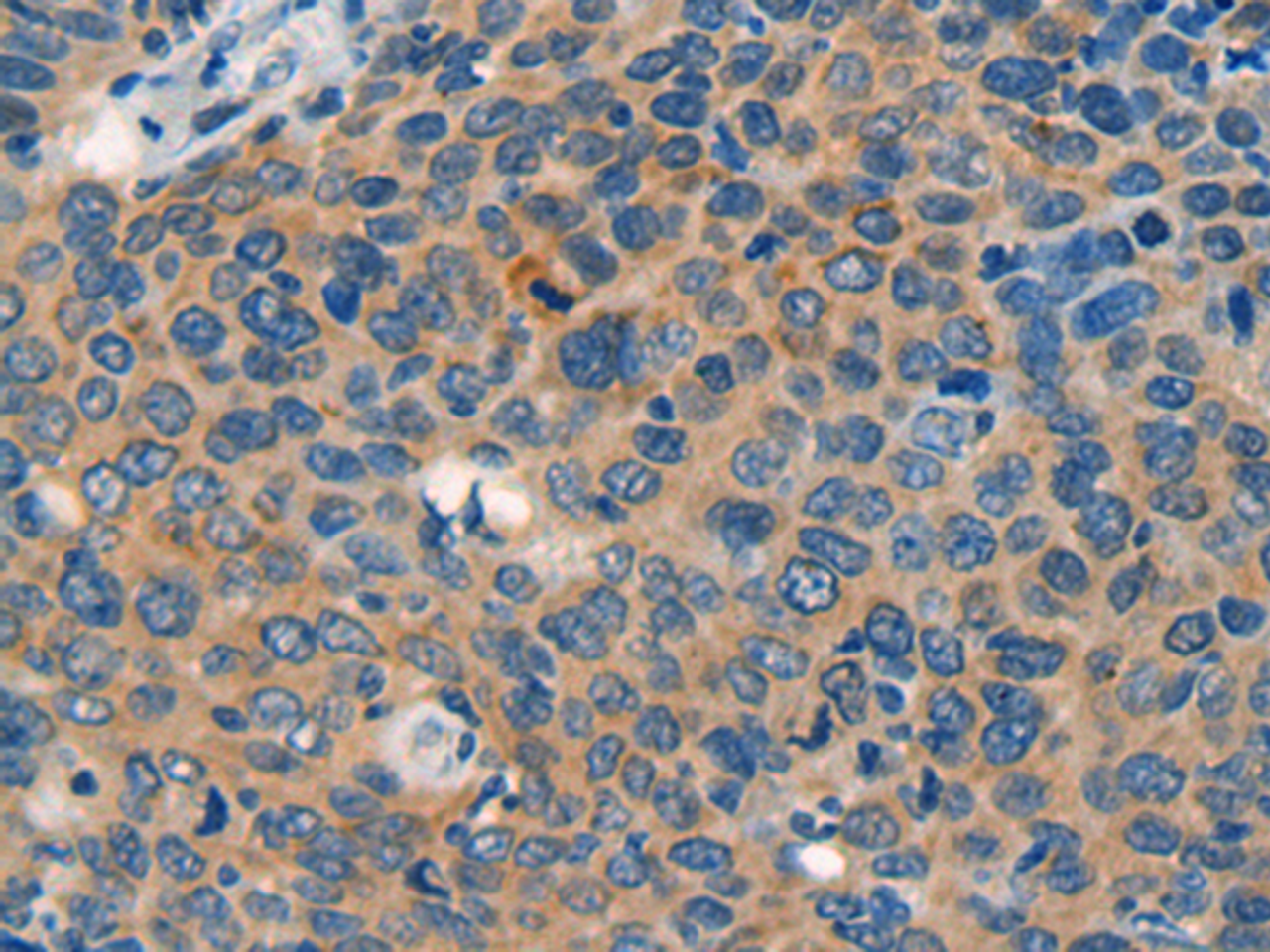 Immunohistochemistry of paraffin-embedded Human cervical cancer tissue  using CASP4 Polyclonal Antibody at dilution of 1:40(×200)