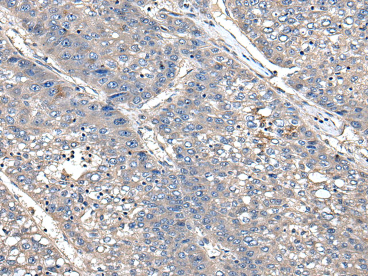 Immunohistochemistry of paraffin-embedded Human liver cancer tissue  using XDH Polyclonal Antibody at dilution of 1:85(×200)