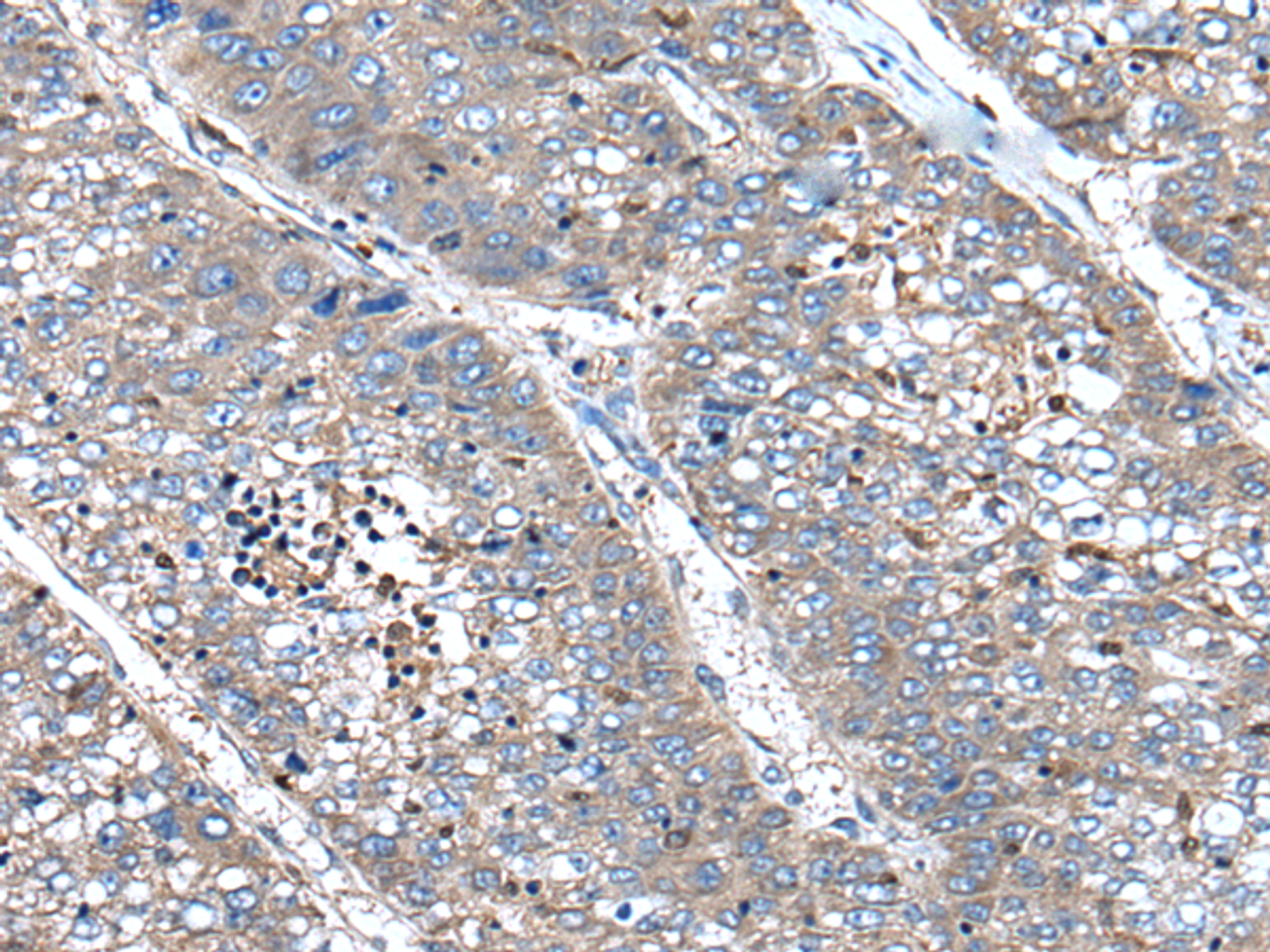 Immunohistochemistry of paraffin-embedded Human liver cancer tissue  using XIRP1 Polyclonal Antibody at dilution of 1:90(×200)