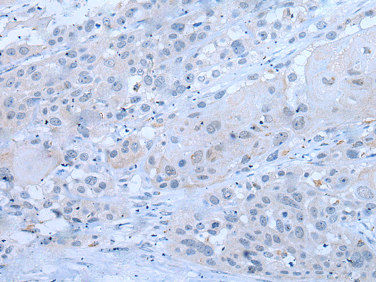 Immunohistochemistry of paraffin-embedded Human esophagus cancer tissue  using XRN1 Polyclonal Antibody at dilution of 1:25(×200)