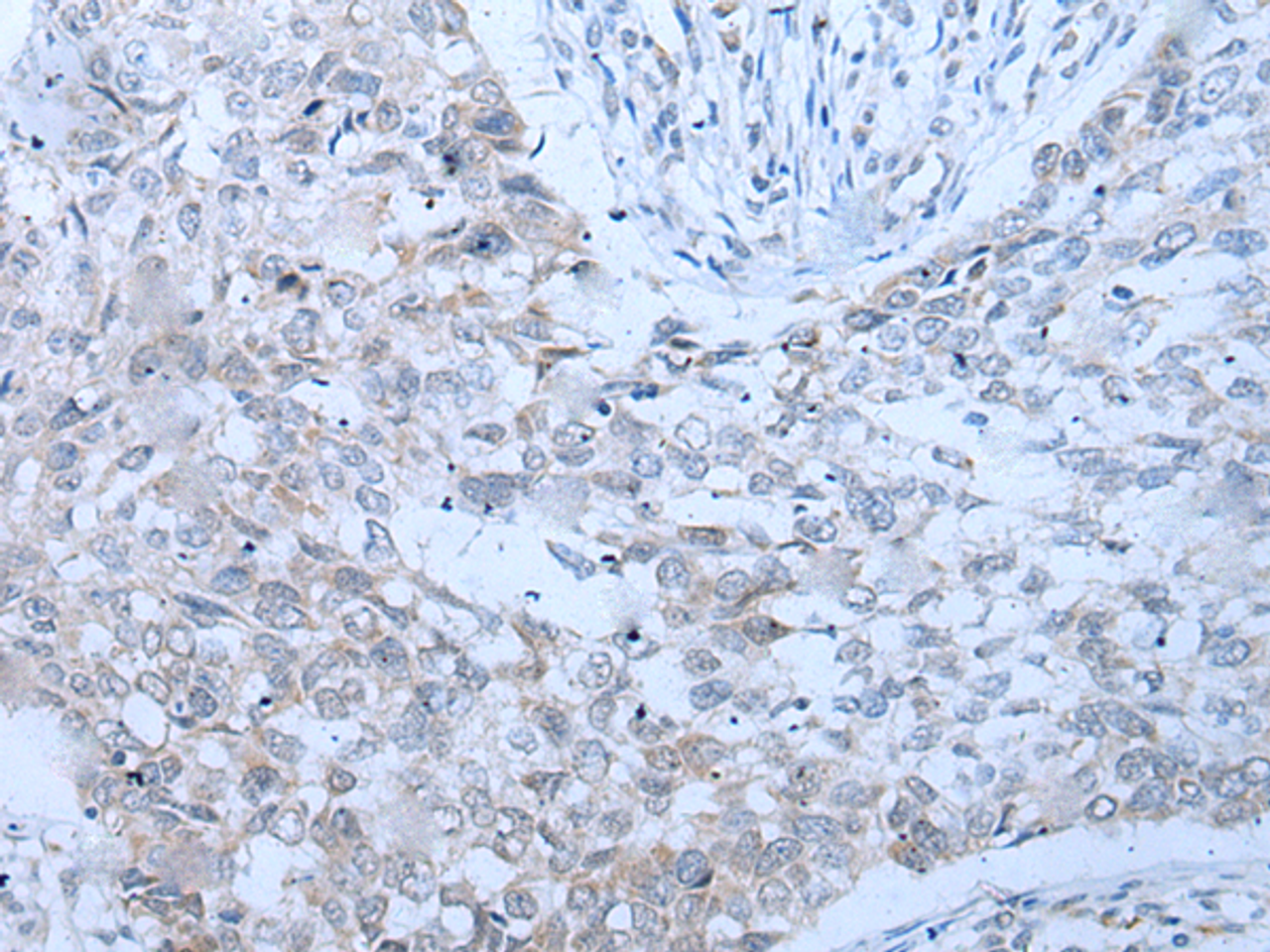 Immunohistochemistry of paraffin-embedded Human lung cancer tissue  using XRN1 Polyclonal Antibody at dilution of 1:25(×200)