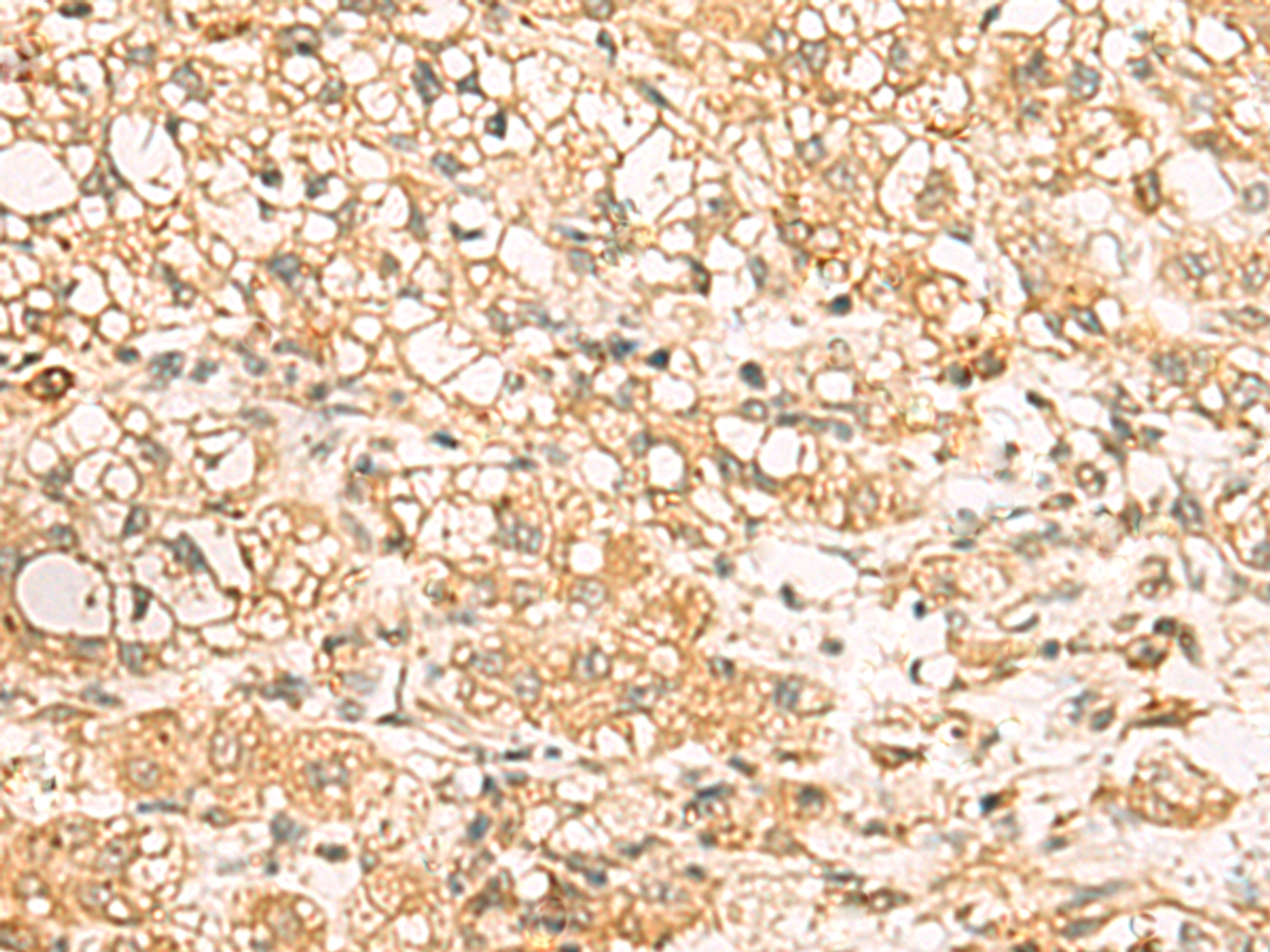 Immunohistochemistry of paraffin-embedded Human liver cancer tissue  using USP24 Polyclonal Antibody at dilution of 1:35(×200)