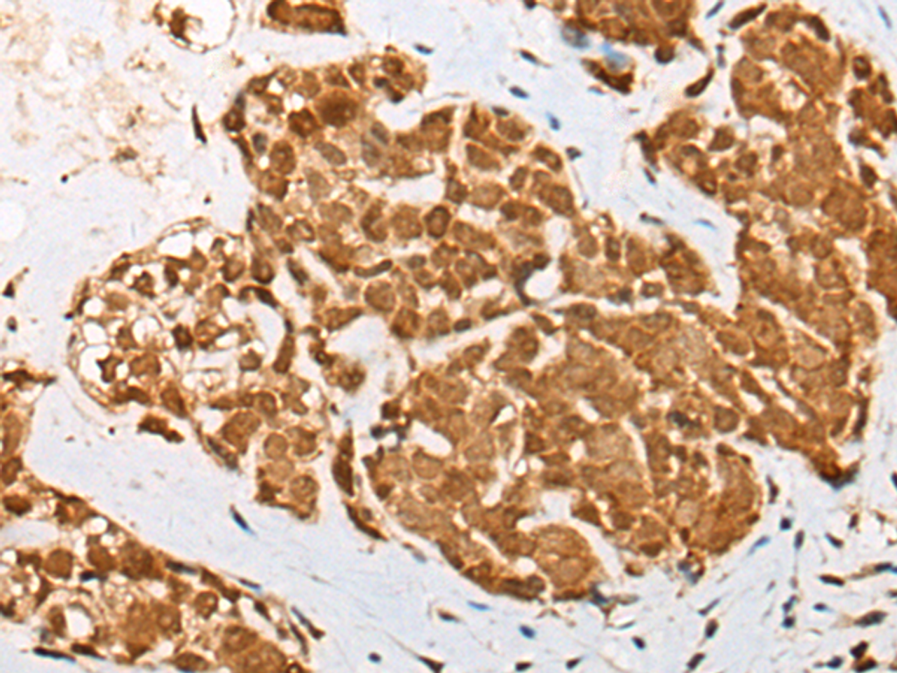 Immunohistochemistry of paraffin-embedded Human thyroid cancer tissue  using ATN1 Polyclonal Antibody at dilution of 1:50(×200)