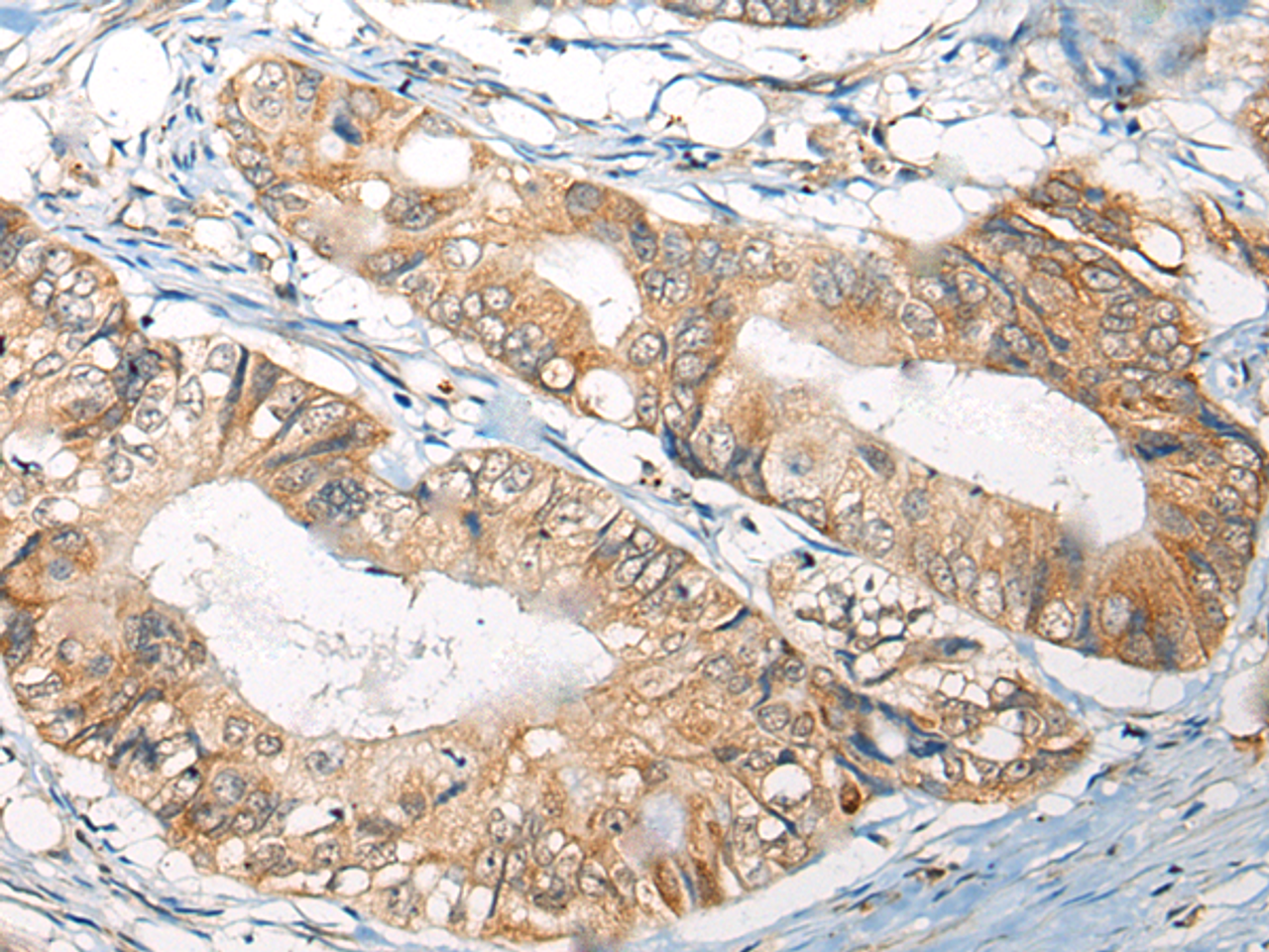 Immunohistochemistry of paraffin-embedded Human colorectal cancer tissue  using B4GAT1 Polyclonal Antibody at dilution of 1:110(×200)