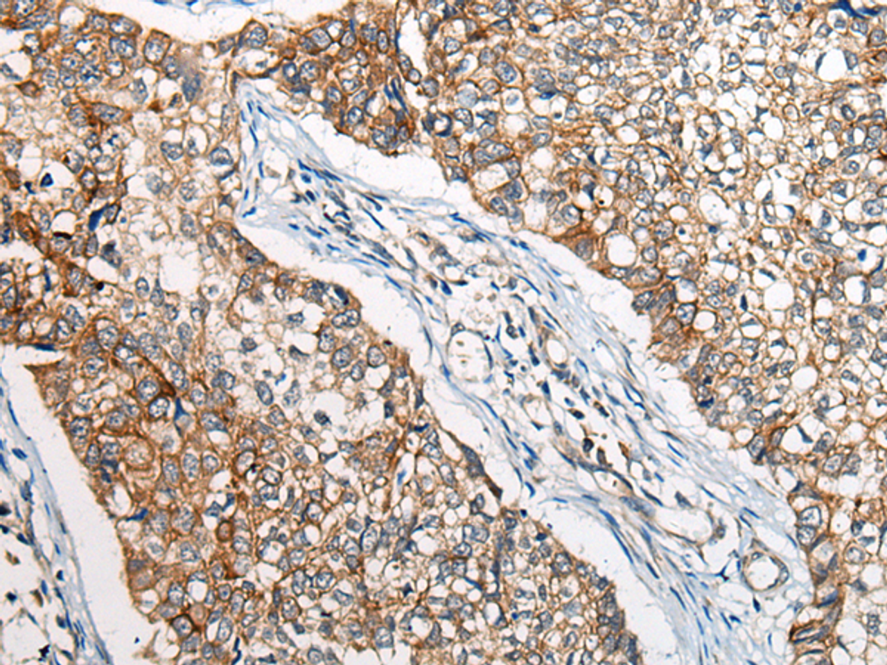 Immunohistochemistry of paraffin-embedded Human lung cancer tissue  using BBS12 Polyclonal Antibody at dilution of 1:50(×200)