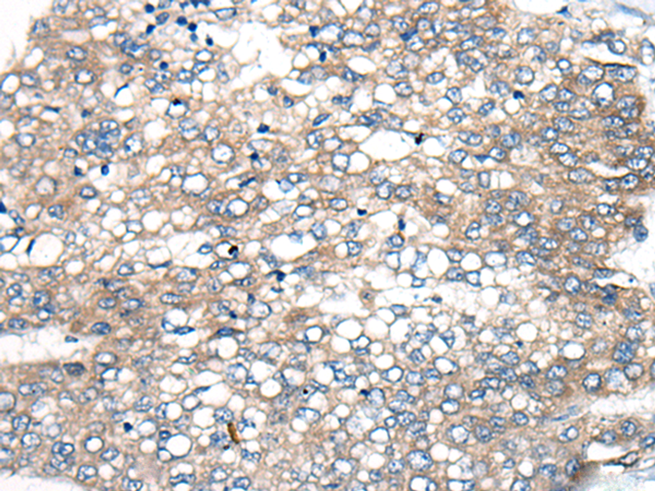 Immunohistochemistry of paraffin-embedded Human liver cancer tissue  using BBS12 Polyclonal Antibody at dilution of 1:50(×200)