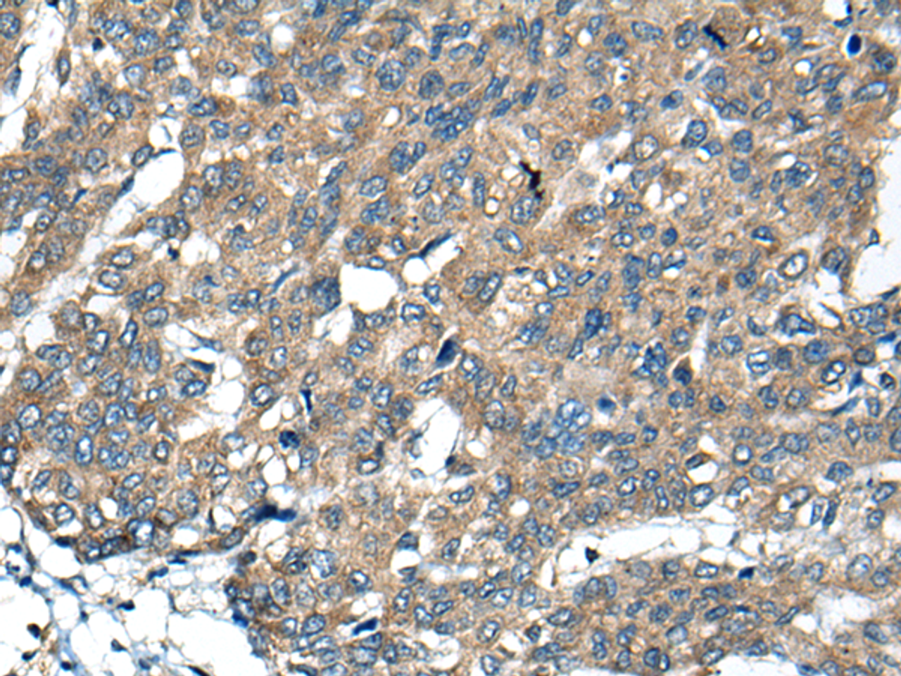 Immunohistochemistry of paraffin-embedded Human liver cancer tissue  using BCL2L2 Polyclonal Antibody at dilution of 1:40(×200)