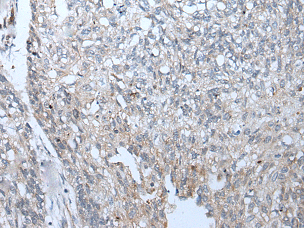 Immunohistochemistry of paraffin-embedded Human lung cancer tissue  using BICD2 Polyclonal Antibody at dilution of 1:70(×200)