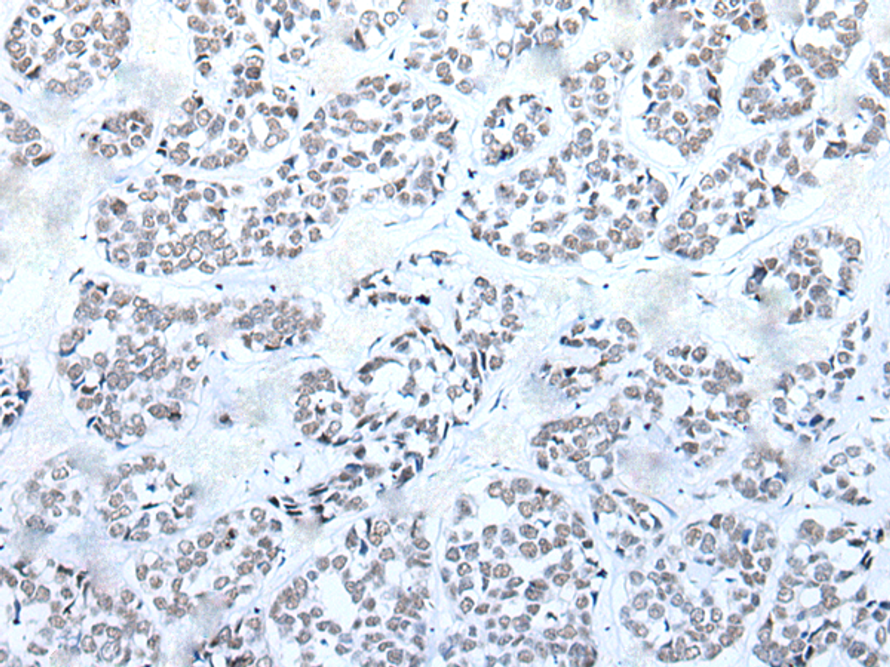 Immunohistochemistry of paraffin-embedded Human esophagus cancer tissue  using BRD3 Polyclonal Antibody at dilution of 1:60(×200)