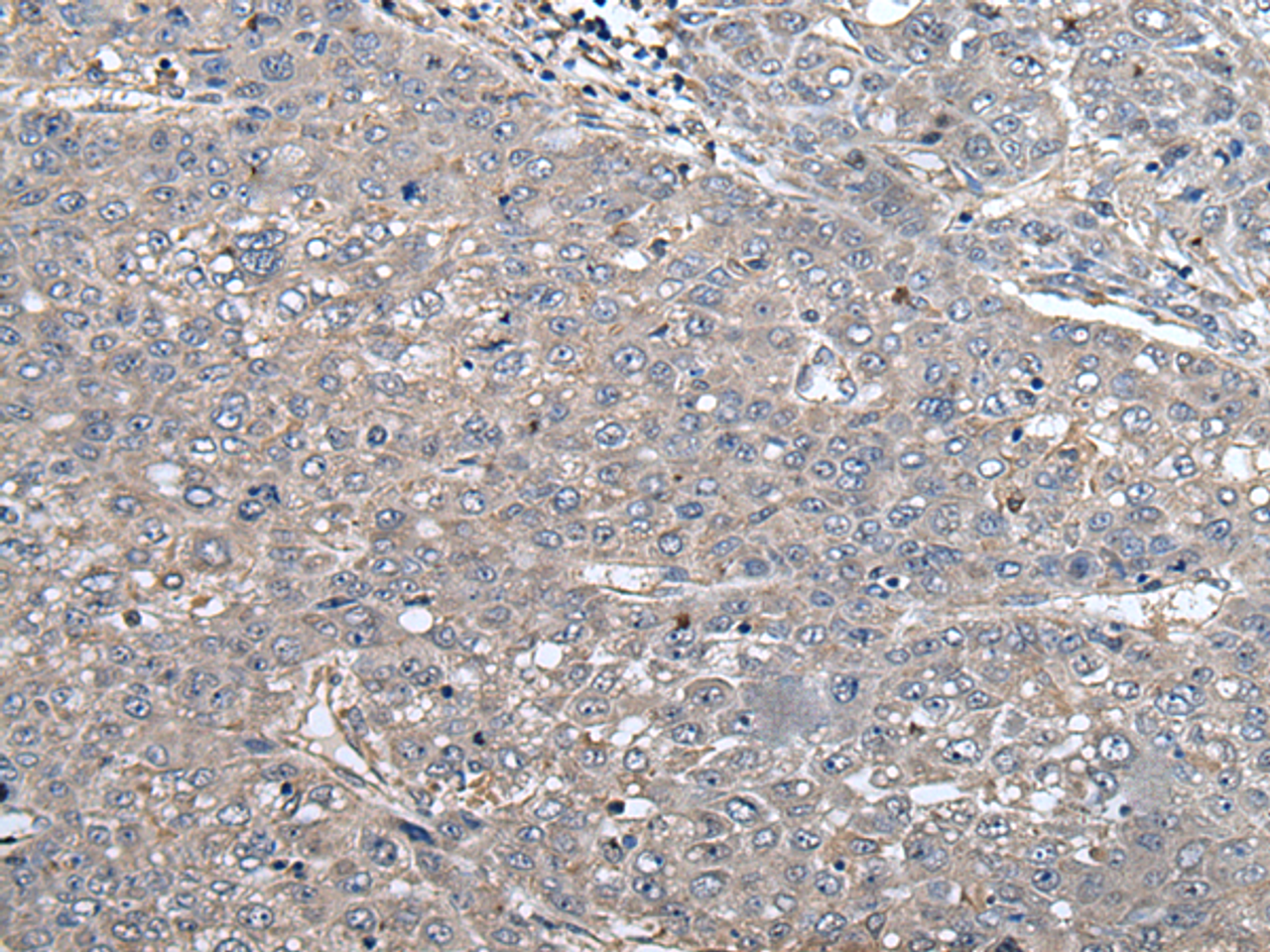 Immunohistochemistry of paraffin-embedded Human liver cancer tissue  using ARL1 Polyclonal Antibody at dilution of 1:50(×200)