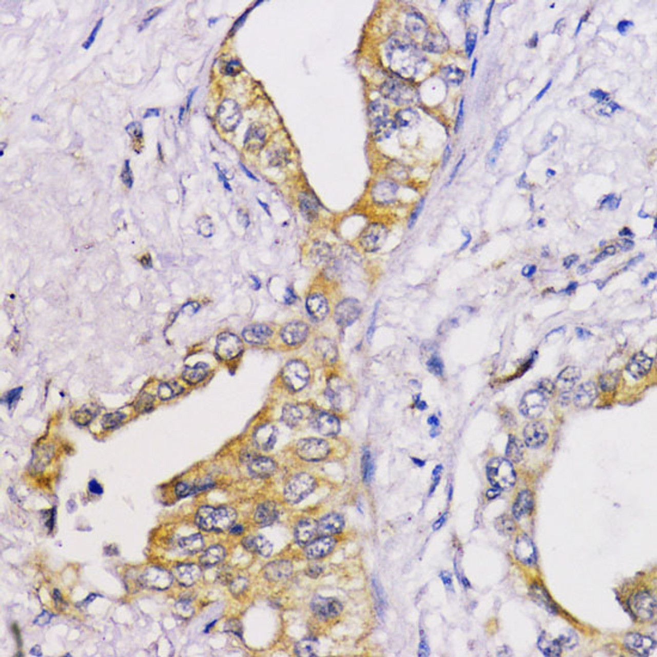 Immunohistochemistry of paraffin-embedded Human lung cancer using Bcl-2 Polyclonal Antibody at dilution of  1:100 (40x lens).