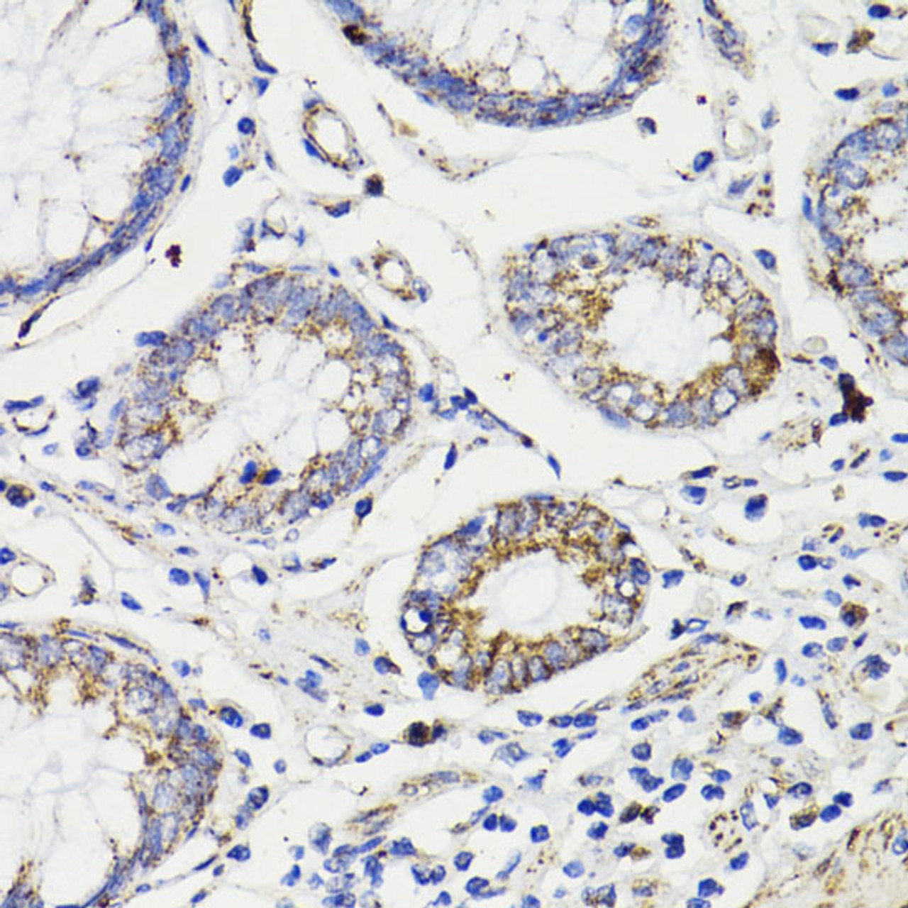 Immunohistochemistry of paraffin-embedded Human colon carcinoma using Caspase-8 Polyclonal Antibody at dilution of  1:200 (40x lens).