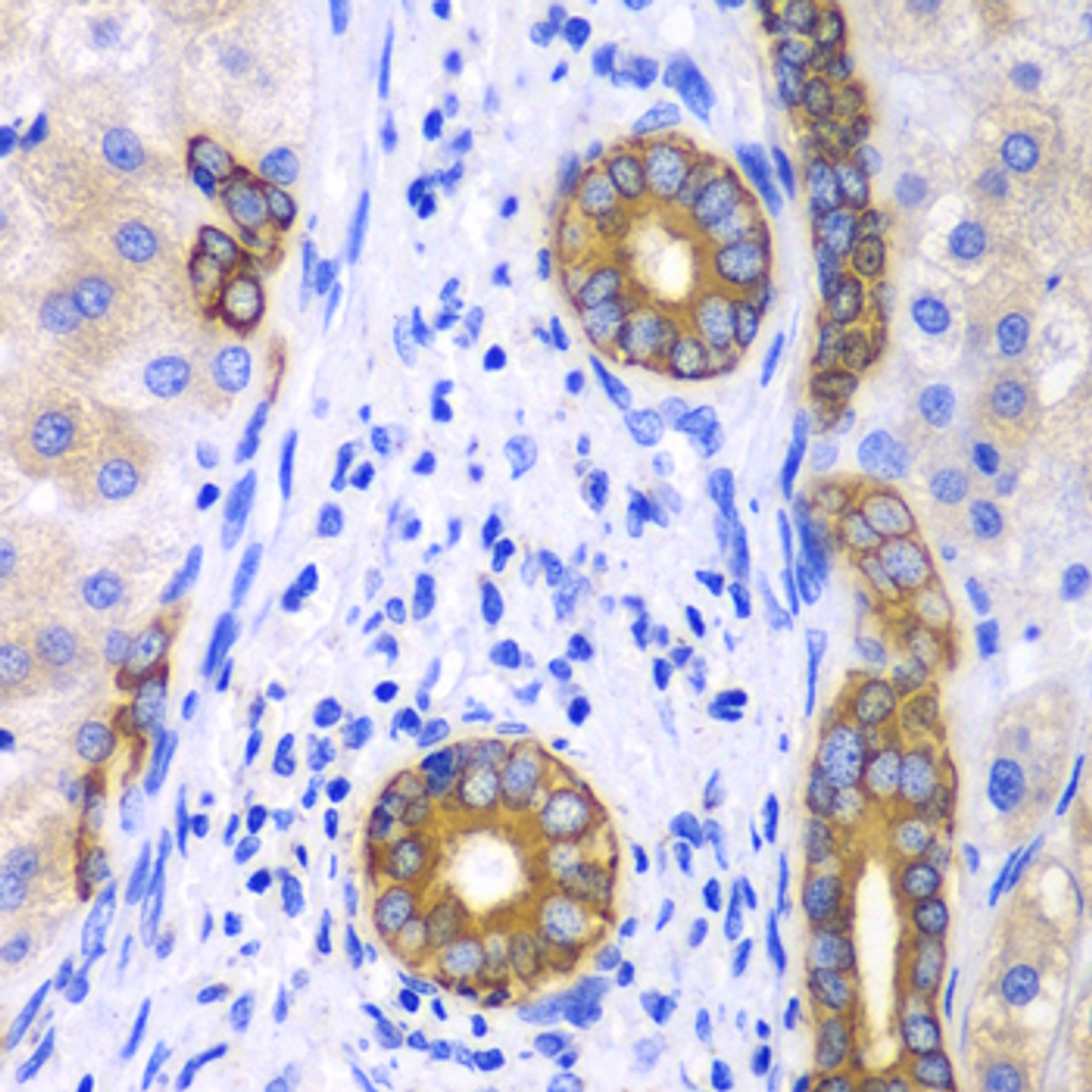 Immunohistochemistry of paraffin-embedded Human liver cancer using KRT19 Polyclonal Antibody at dilution of  1:100 (40x lens).