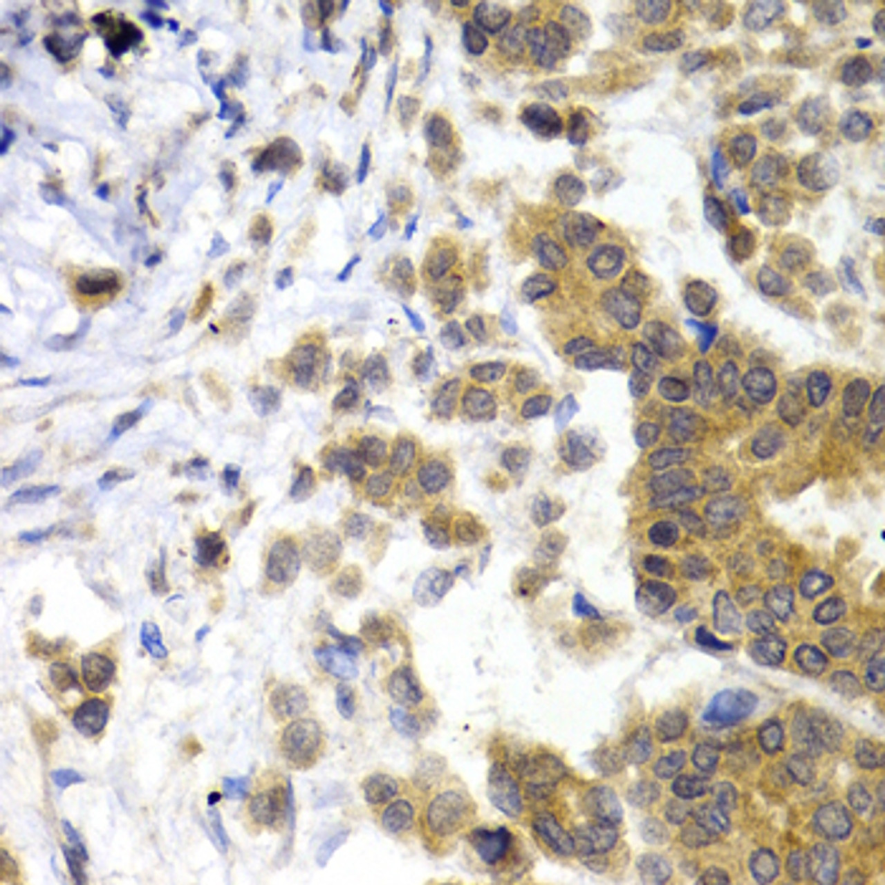 Immunohistochemistry of paraffin-embedded Human breast cancer using NEFL Polyclonal Antibody at dilution of  1:200 (40x lens).