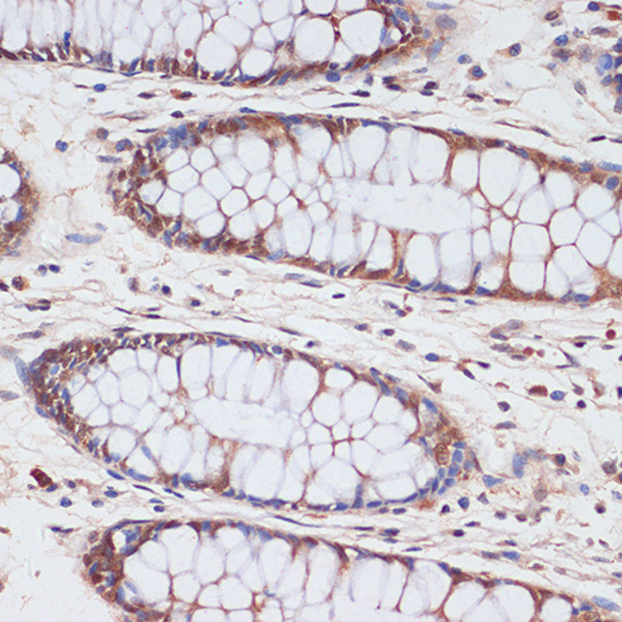 Immunohistochemistry of paraffin-embedded Human colon using CDKN2A / p16INK4a Polyclonal Antibody at dilution of  1:100 (40x lens).