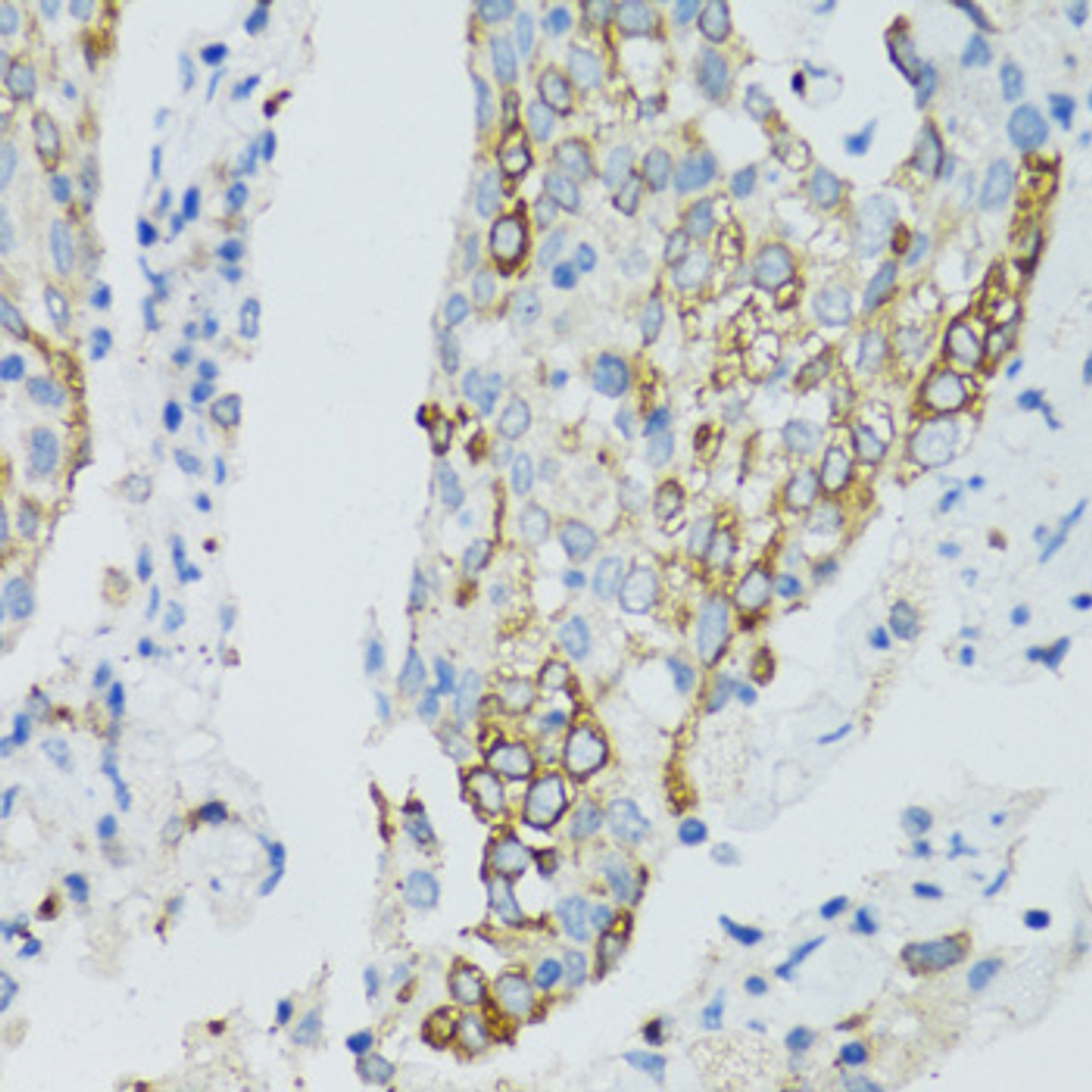 Immunohistochemistry of paraffin-embedded Human lung cancer using SIRT2 Polyclonal Antibody at dilution of  1:100 (40x lens).