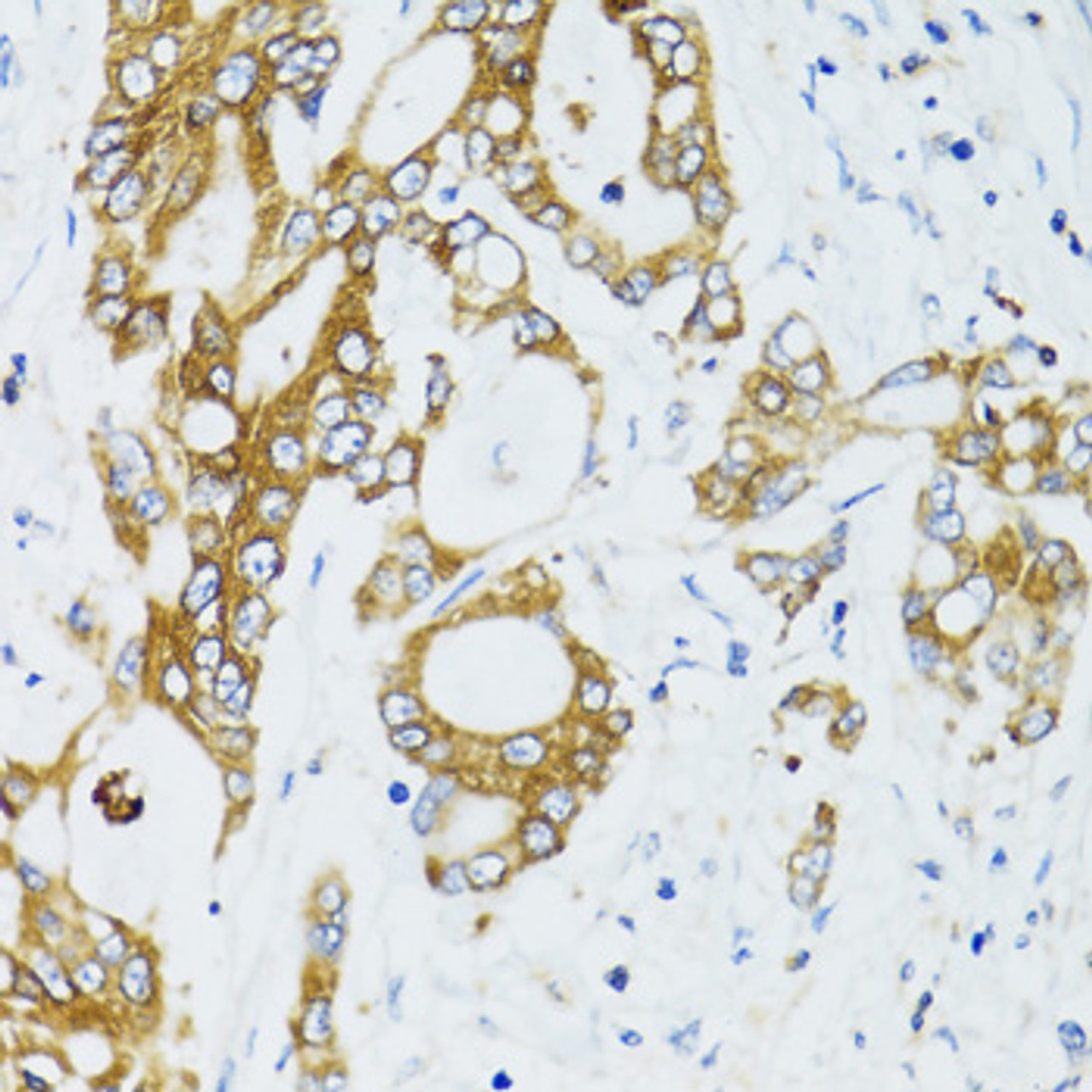 Immunohistochemistry of paraffin-embedded Human colon carcinoma using SIRT2 Polyclonal Antibody at dilution of  1:100 (40x lens).