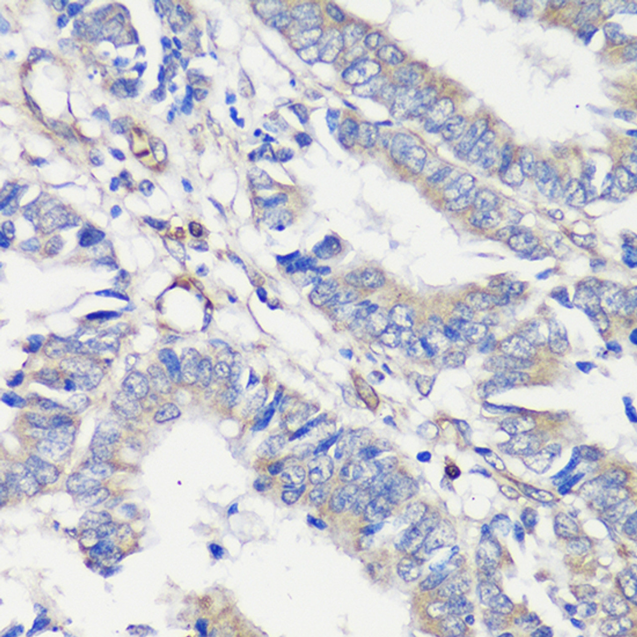 Immunohistochemistry of paraffin-embedded Human colon carcinoma using TNF-α Polyclonal Antibody at dilution of  1:100  (40x lens).