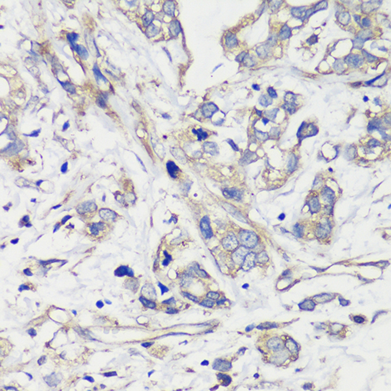 Immunohistochemistry of paraffin-embedded Human gastric cancer using TNF-α Polyclonal Antibody at dilution of  1:100  (40x lens).