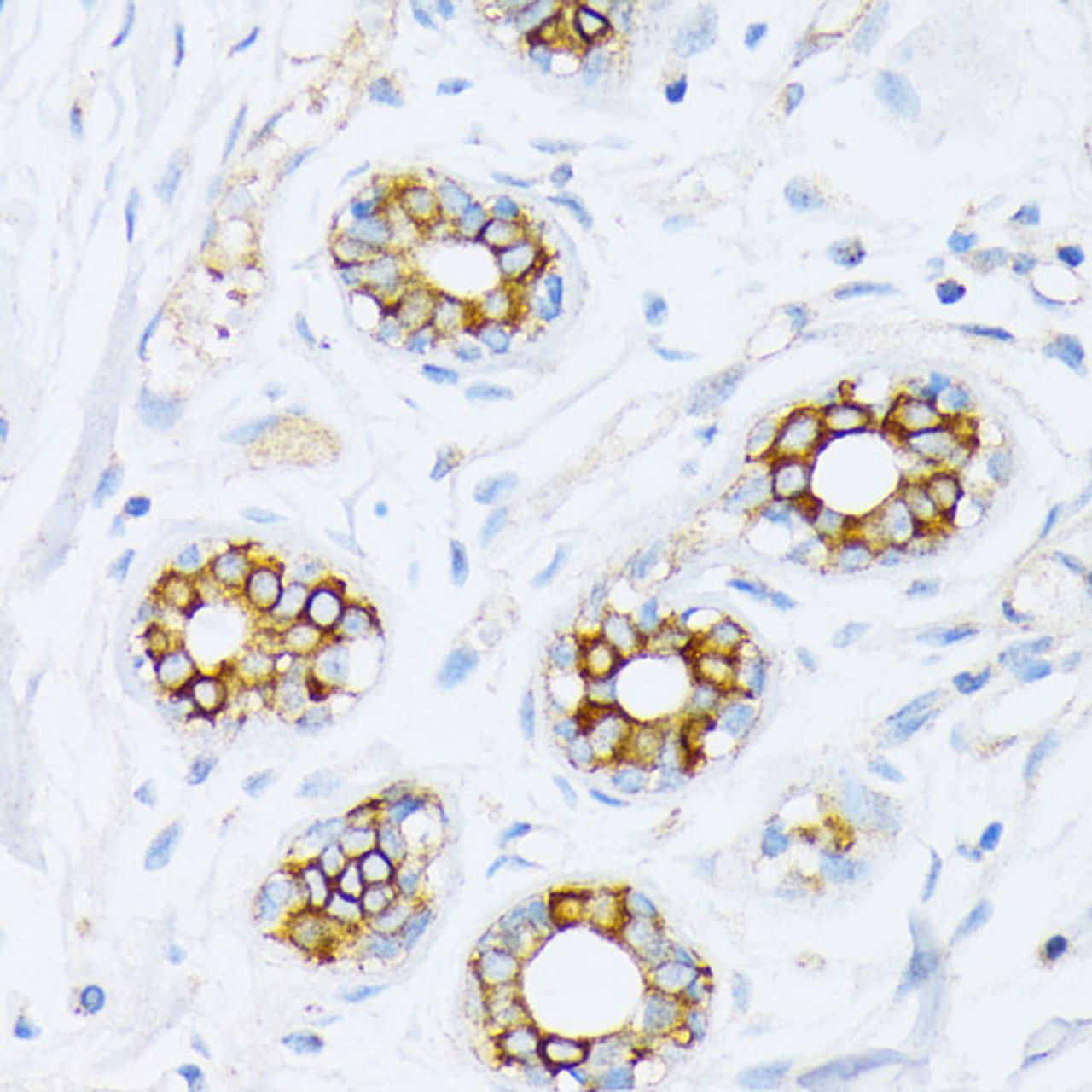 Immunohistochemistry of paraffin-embedded Human breast cancer using Fatty Acid Synthase Polyclonal Antibody at dilution of  1:200 (40x lens).