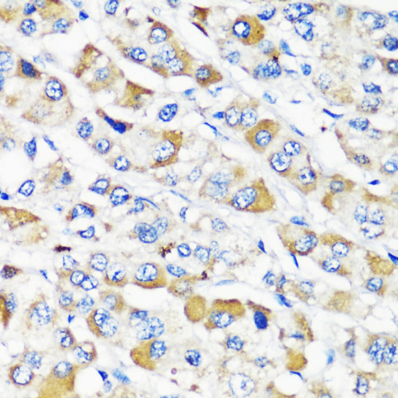 Immunohistochemistry of paraffin-embedded Human liver cancer using TSC2 Polyclonal Antibody at dilution of  1:200 (40x lens).