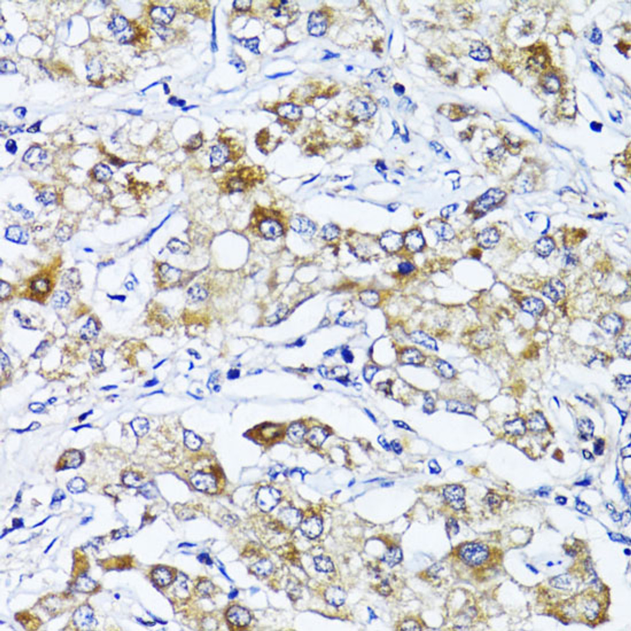 Immunohistochemistry of paraffin-embedded Human liver cancer using SOCS3 Polyclonal Antibody at dilution of  1:100 (40x lens).
