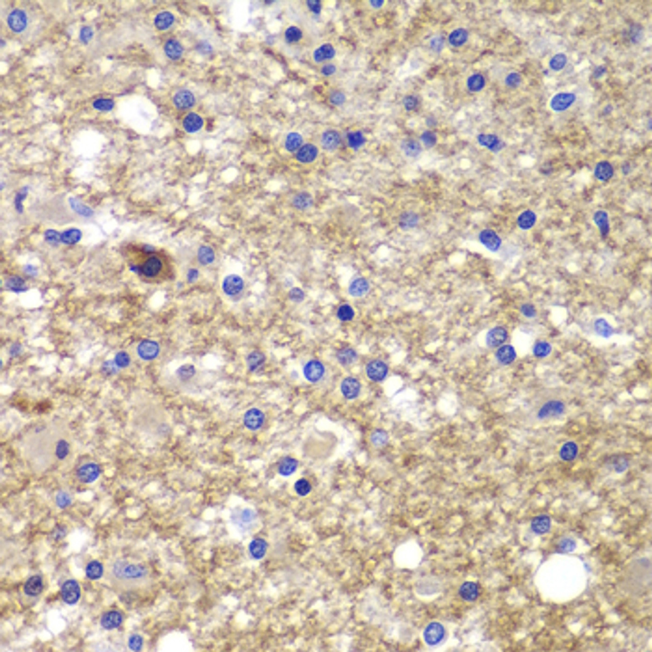 Immunohistochemistry of paraffin-embedded Human brain cancer using CDK6 Polyclonal Antibody at dilution of  1:100 (40x lens).