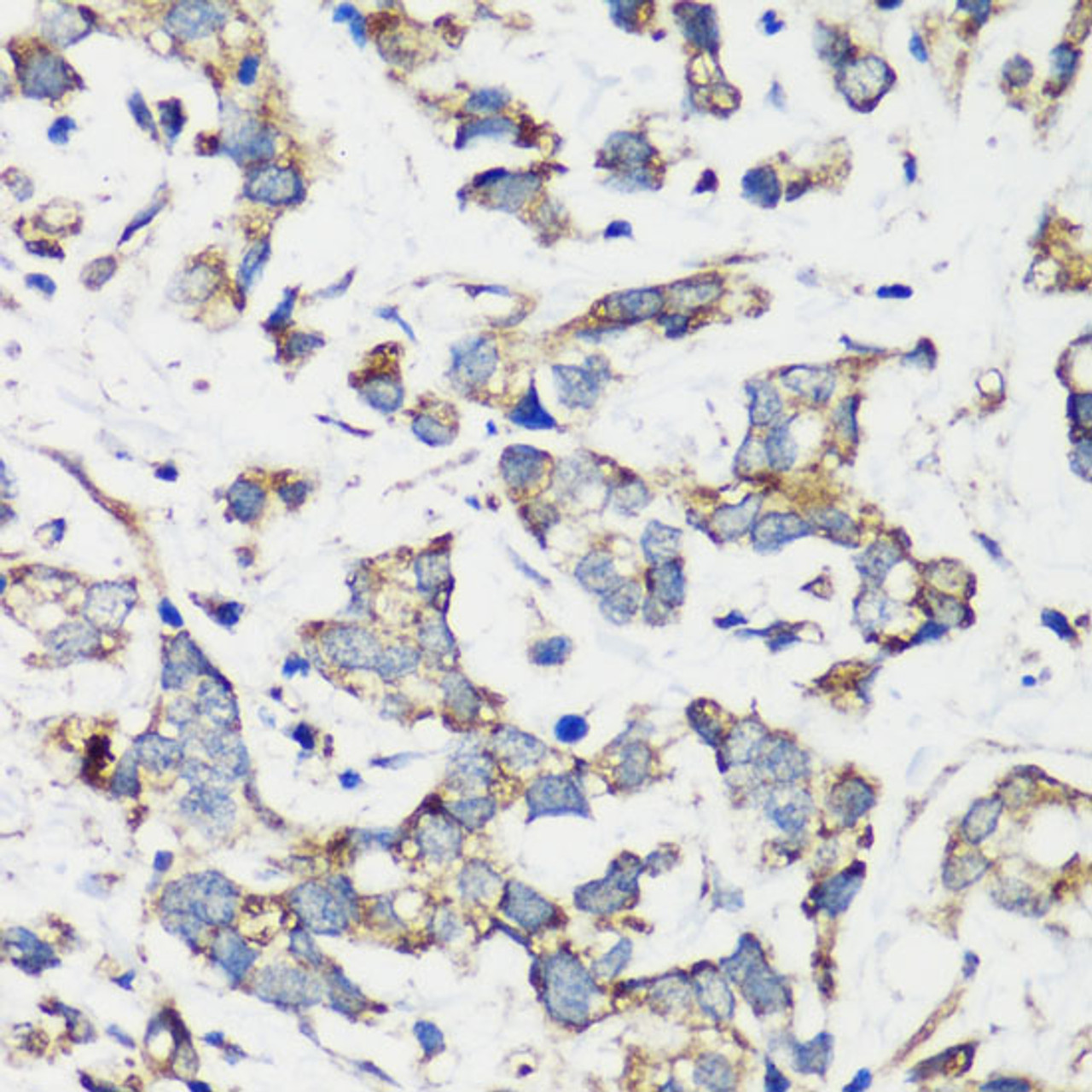 Immunohistochemistry of paraffin-embedded Human gastric cancer using TSC1 Polyclonal Antibody at dilution of  1:200 (40x lens).