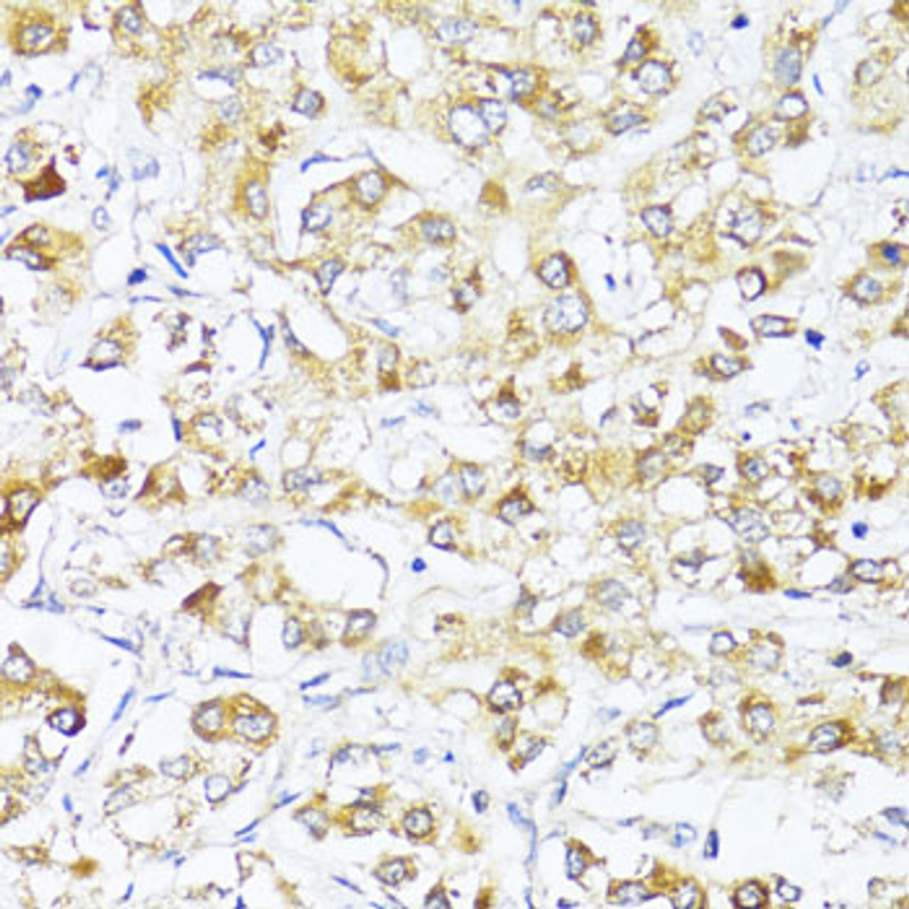 Immunohistochemistry of paraffin-embedded Human liver cancer using EIF2S1 Polyclonal Antibody at dilution of  1:100 (40x lens).