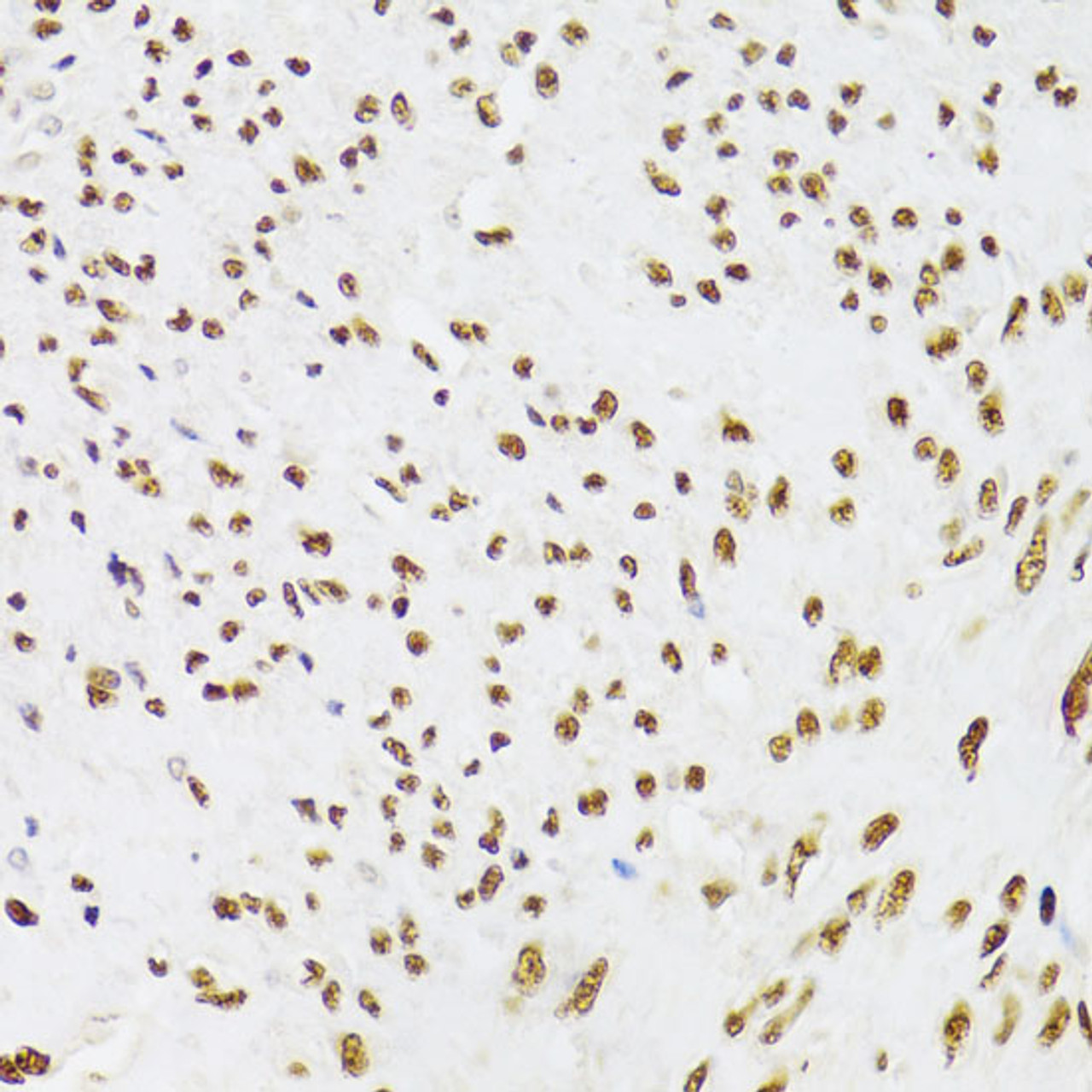 Immunohistochemistry of paraffin-embedded Human leiomyoma of uterus using KU70 Polyclonal Antibody at dilution of  1:100 (40x lens).