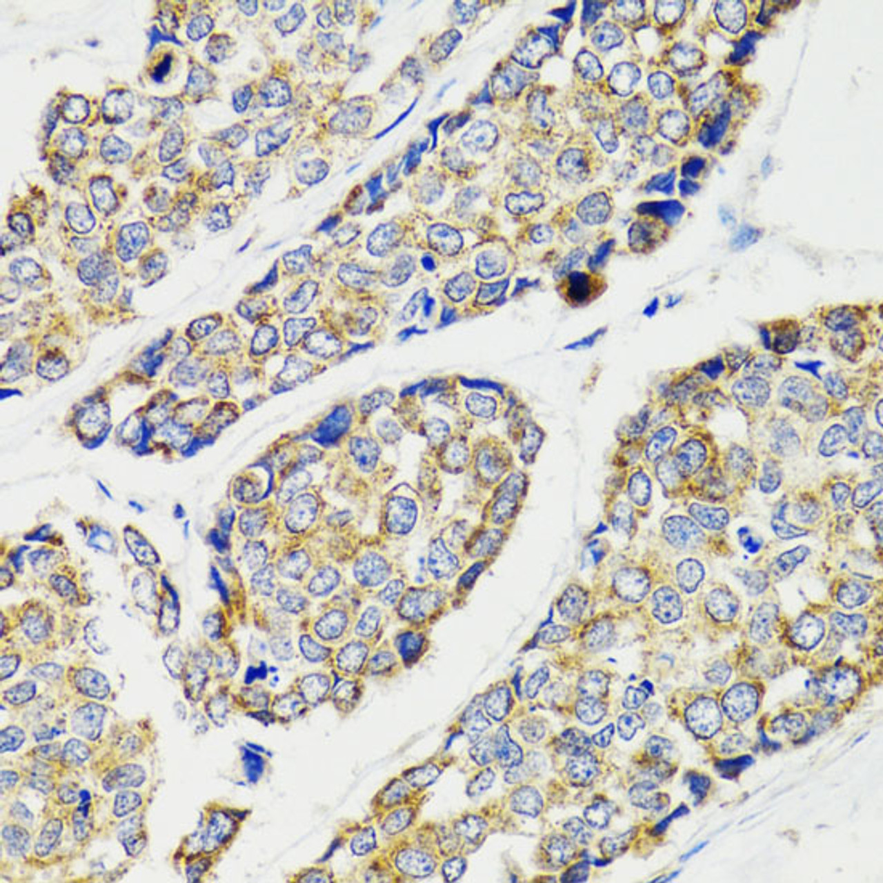 Immunohistochemistry of paraffin-embedded Human esophageal cancer using IKBKG Polyclonal Antibody at dilution of  1:100 (40x lens).