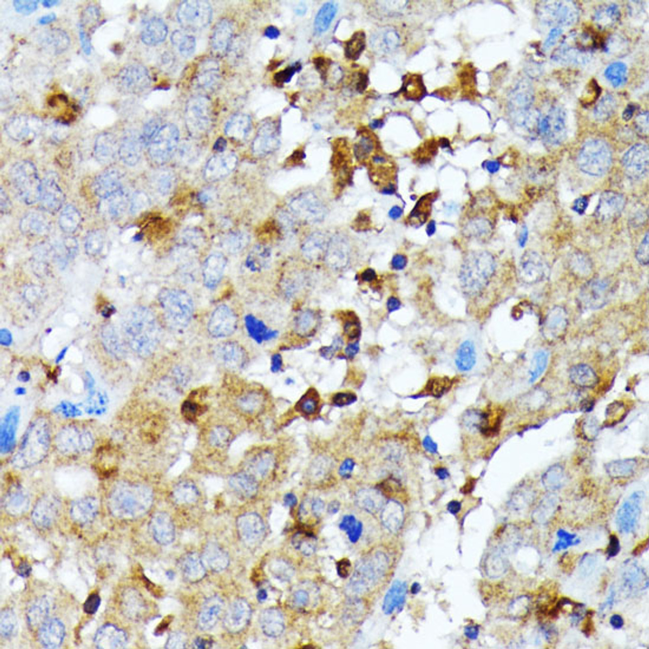 Immunohistochemistry of paraffin-embedded Human liver cancer using Caspase-1 Polyclonal Antibody at dilution of  1:100 (40x lens).