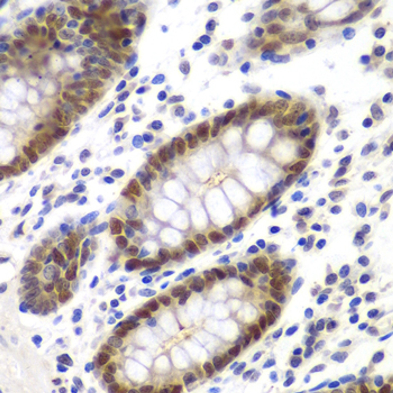 Immunohistochemistry of paraffin-embedded Human colon using MSH6 Polyclonal Antibody at dilution of  1:100 (40x lens).