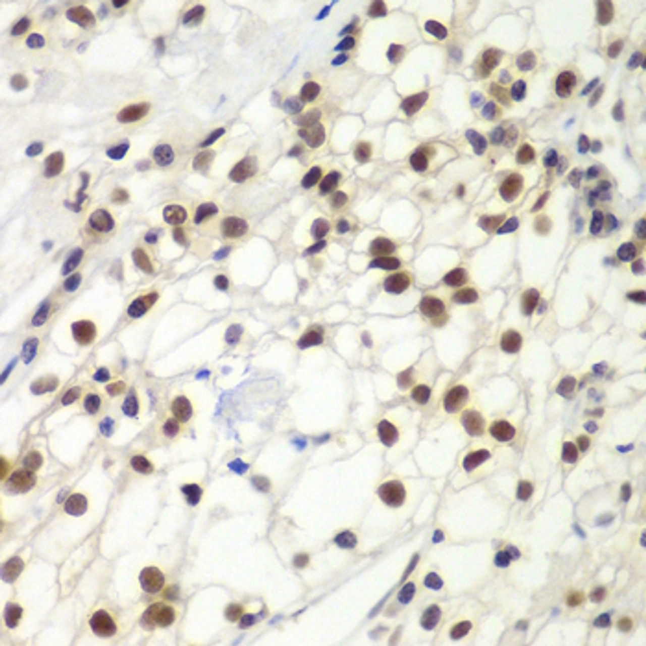 Immunohistochemistry of paraffin-embedded Human kidney cancer using MSH6 Polyclonal Antibody at dilution of  1:100 (40x lens).