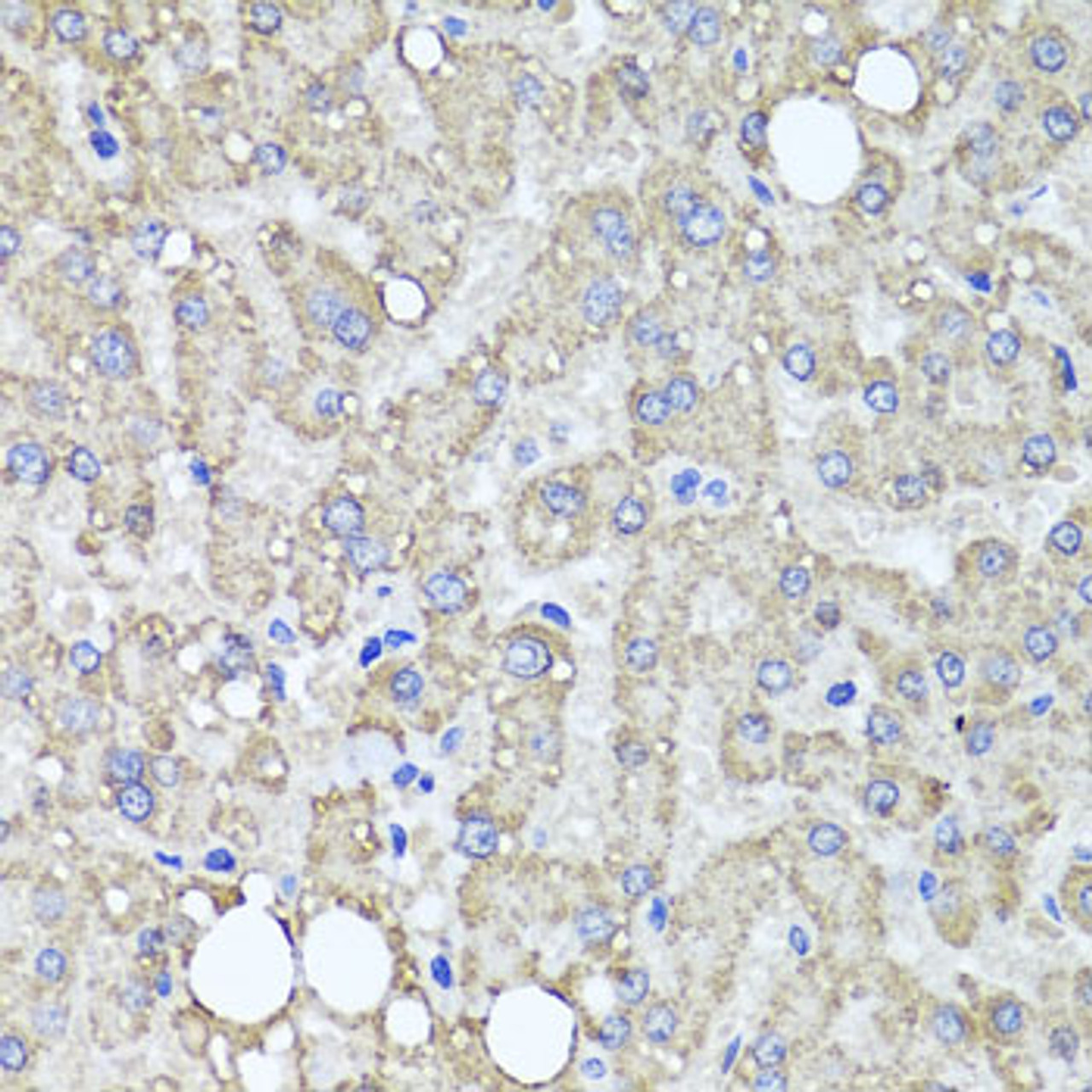 Immunohistochemistry of paraffin-embedded Human liver damage using MUC16 Polyclonal Antibody at dilution of  1:100 (40x lens).