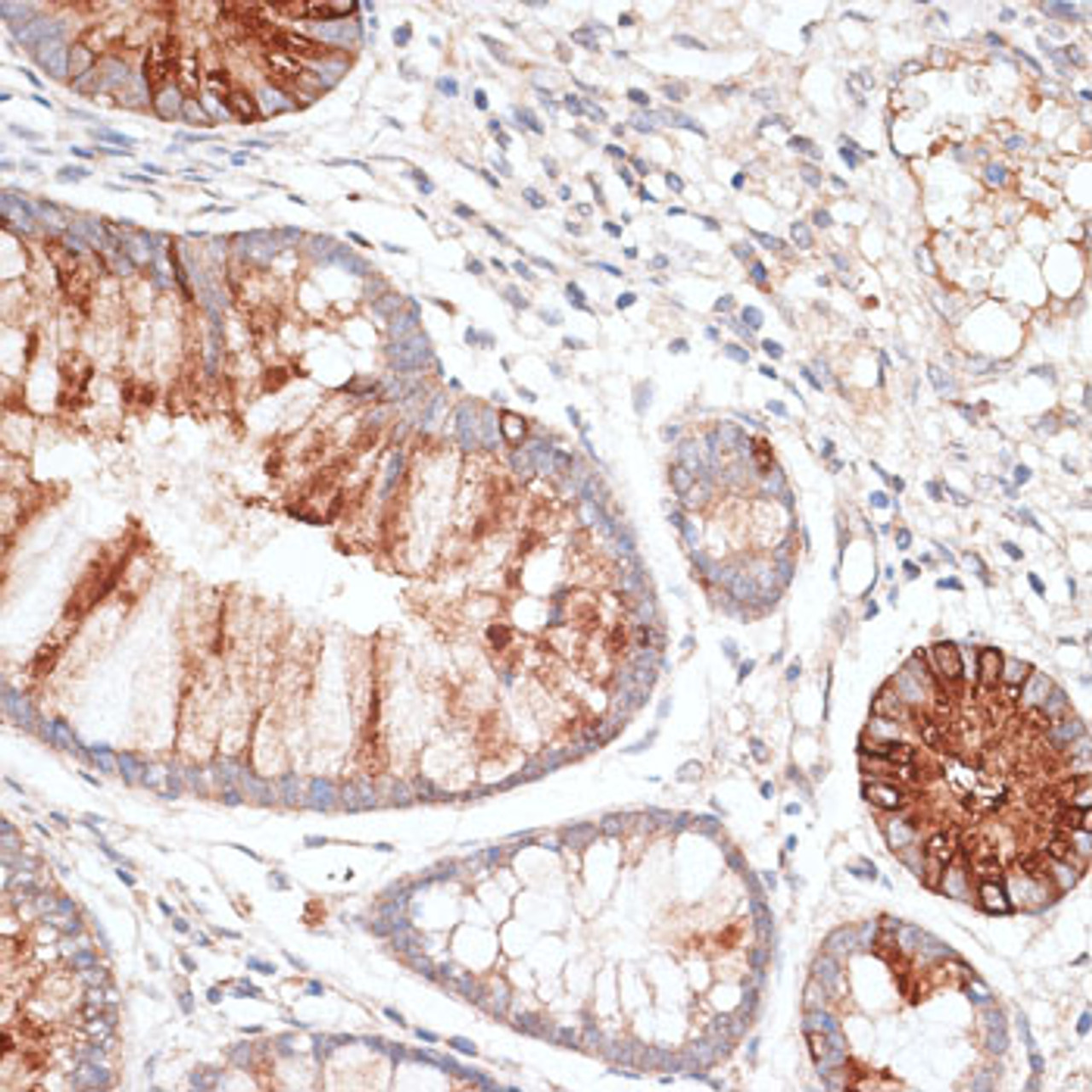 Immunohistochemistry of paraffin-embedded Human colon carcinoma using KIR3DL3 Polyclonal Antibody at dilution of  1:100 (40x lens).