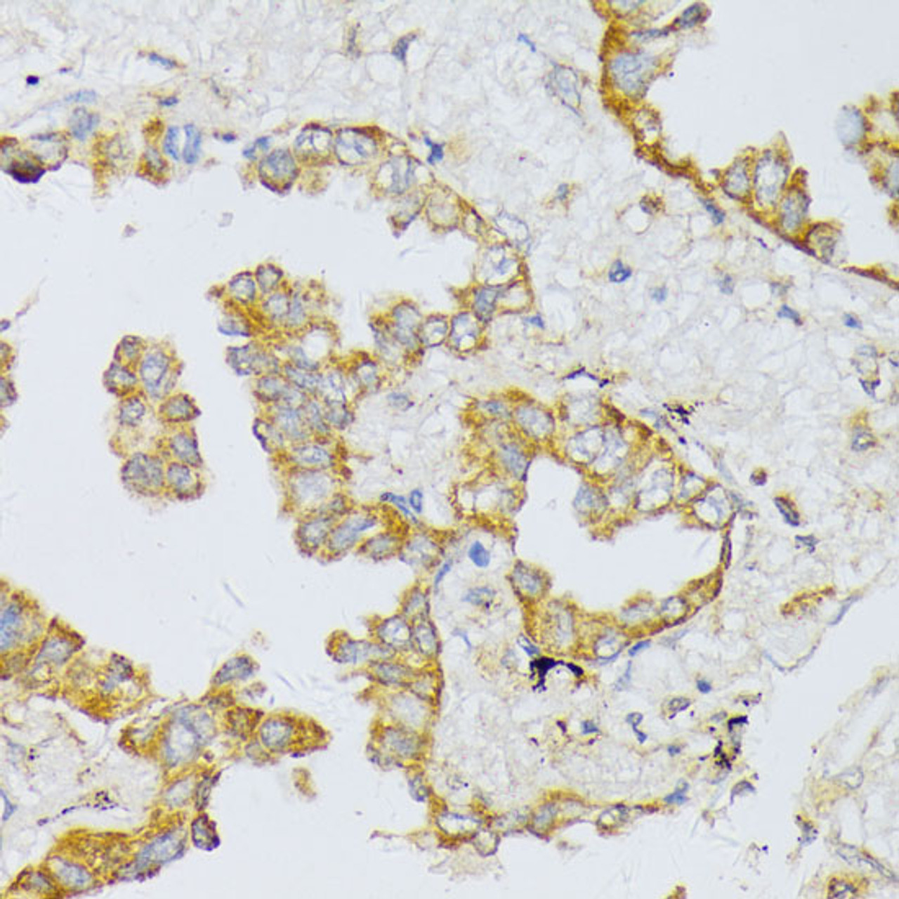 Immunohistochemistry of paraffin-embedded Human lung cancer using ART1 Polyclonal Antibody at dilution of  1:100 (40x lens).