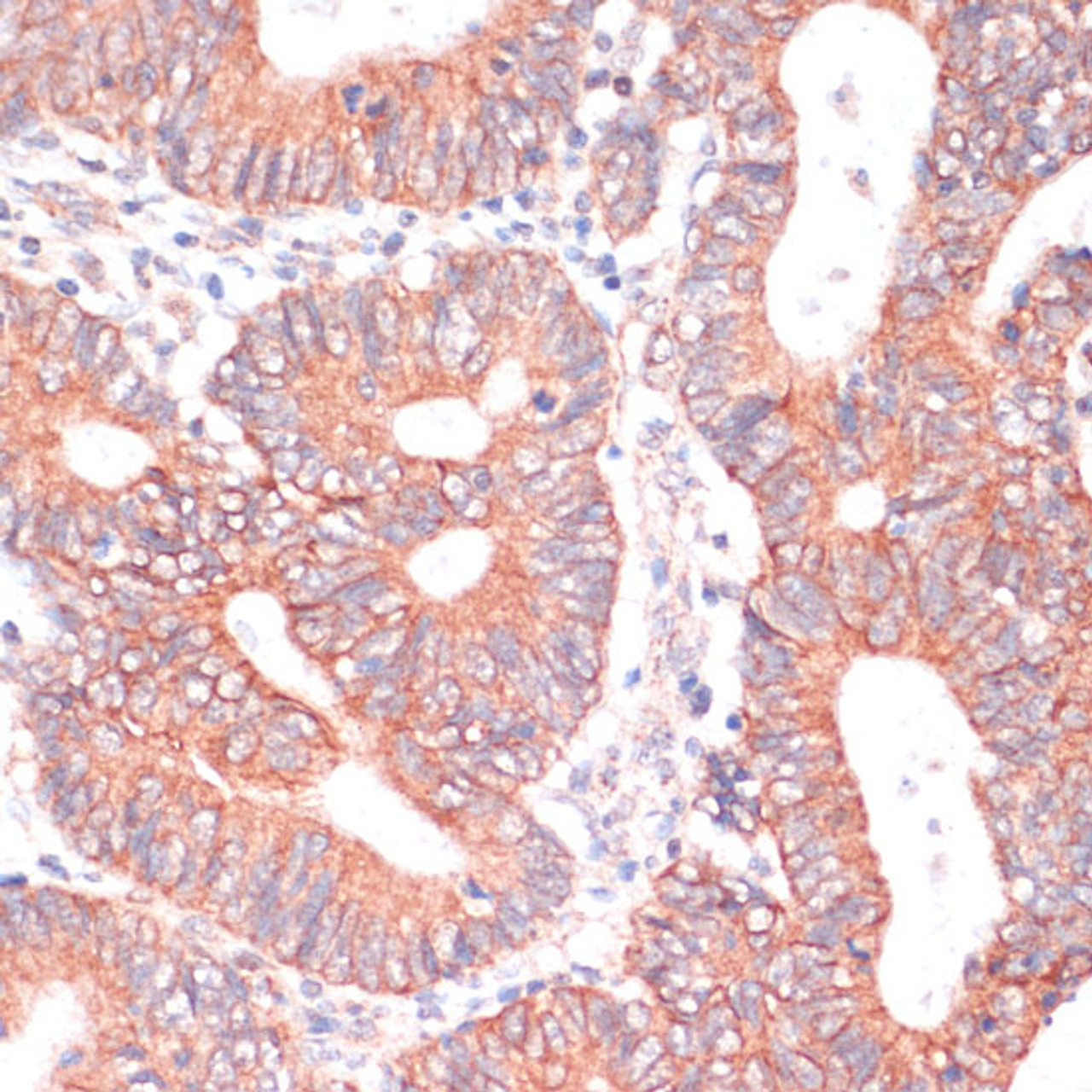 Immunohistochemistry of paraffin-embedded Human colon carcinoma using TIAM1 Polyclonal Antibody at dilution of  1:100 (40x lens).