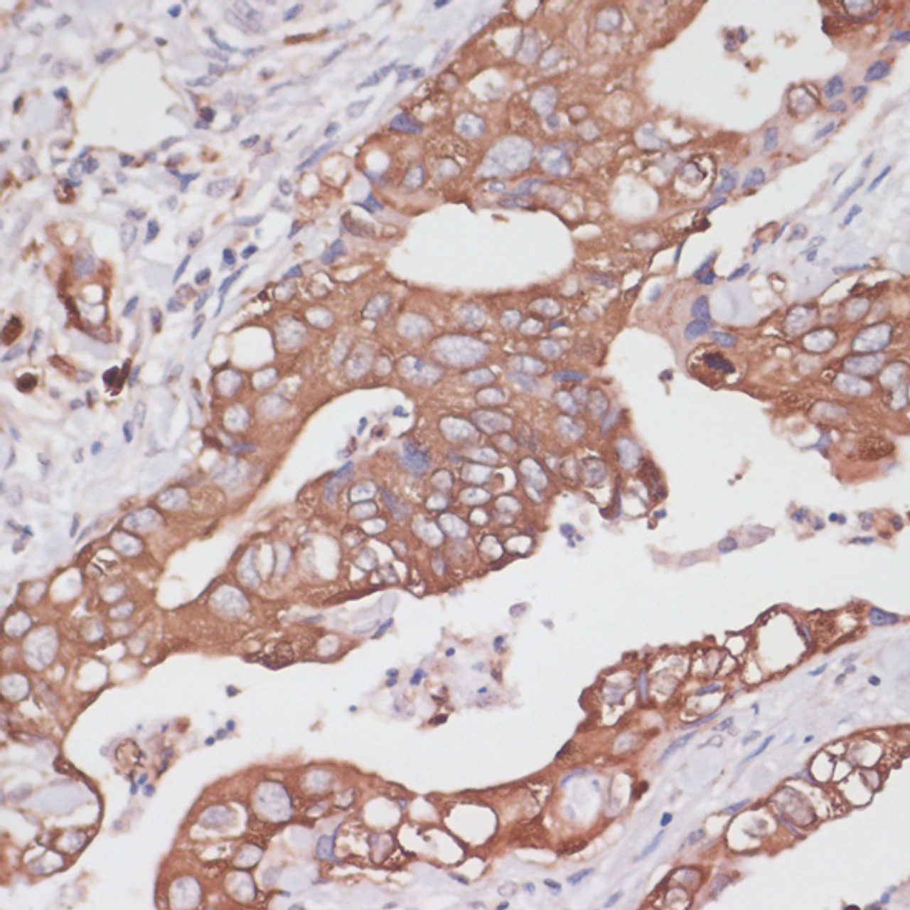 Immunohistochemistry of paraffin-embedded Human colon carcinoma using TPD52 Polyclonal Antibody at dilution of  1:100 (40x lens).