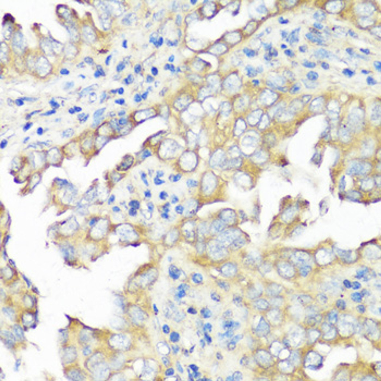 Immunohistochemistry of paraffin-embedded Human lung cancer using EIF3B Polyclonal Antibody at dilution of  1:100 (40x lens).