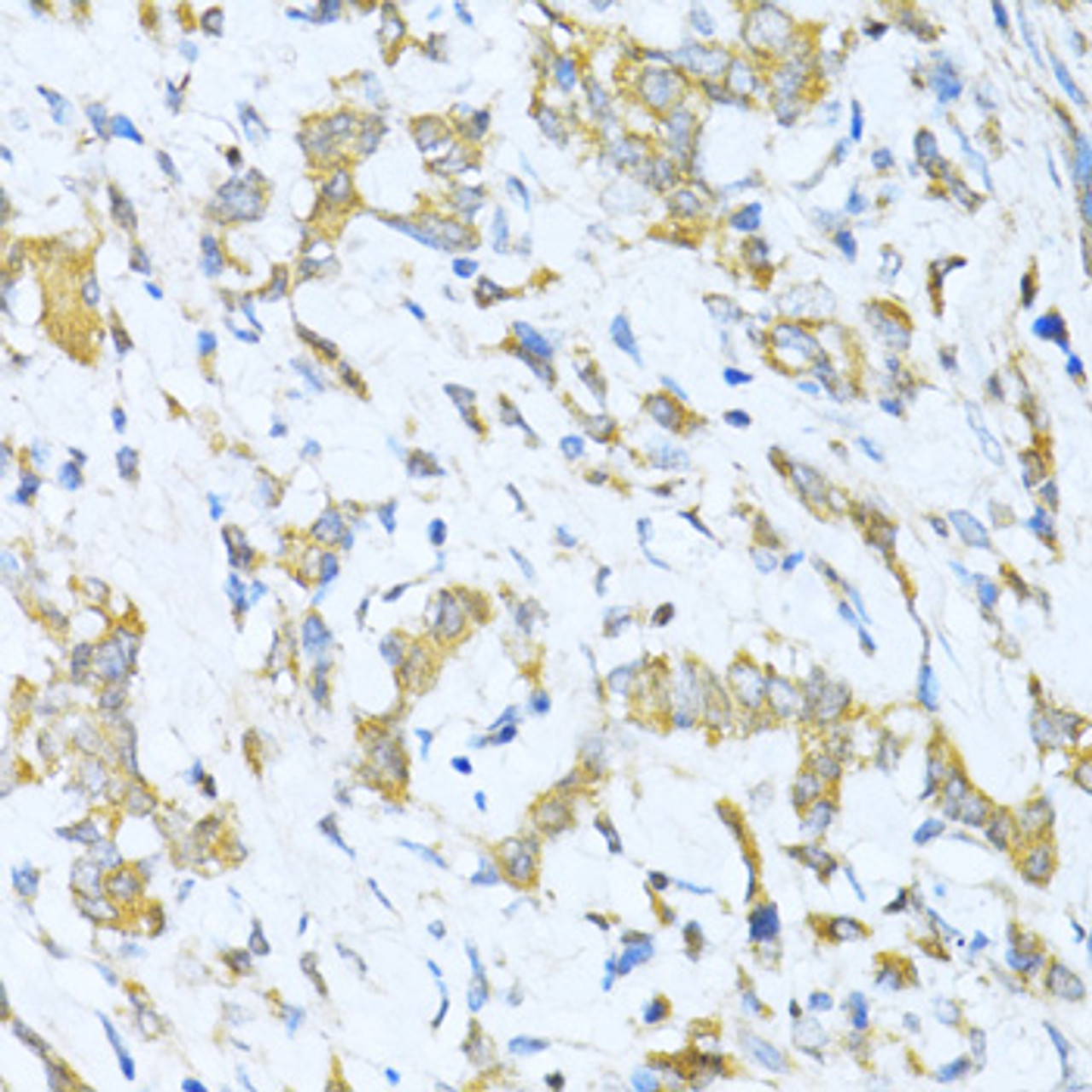 Immunohistochemistry of paraffin-embedded Human gastric cancer using KLHL42 Polyclonal Antibody at dilution of  1:100 (40x lens).