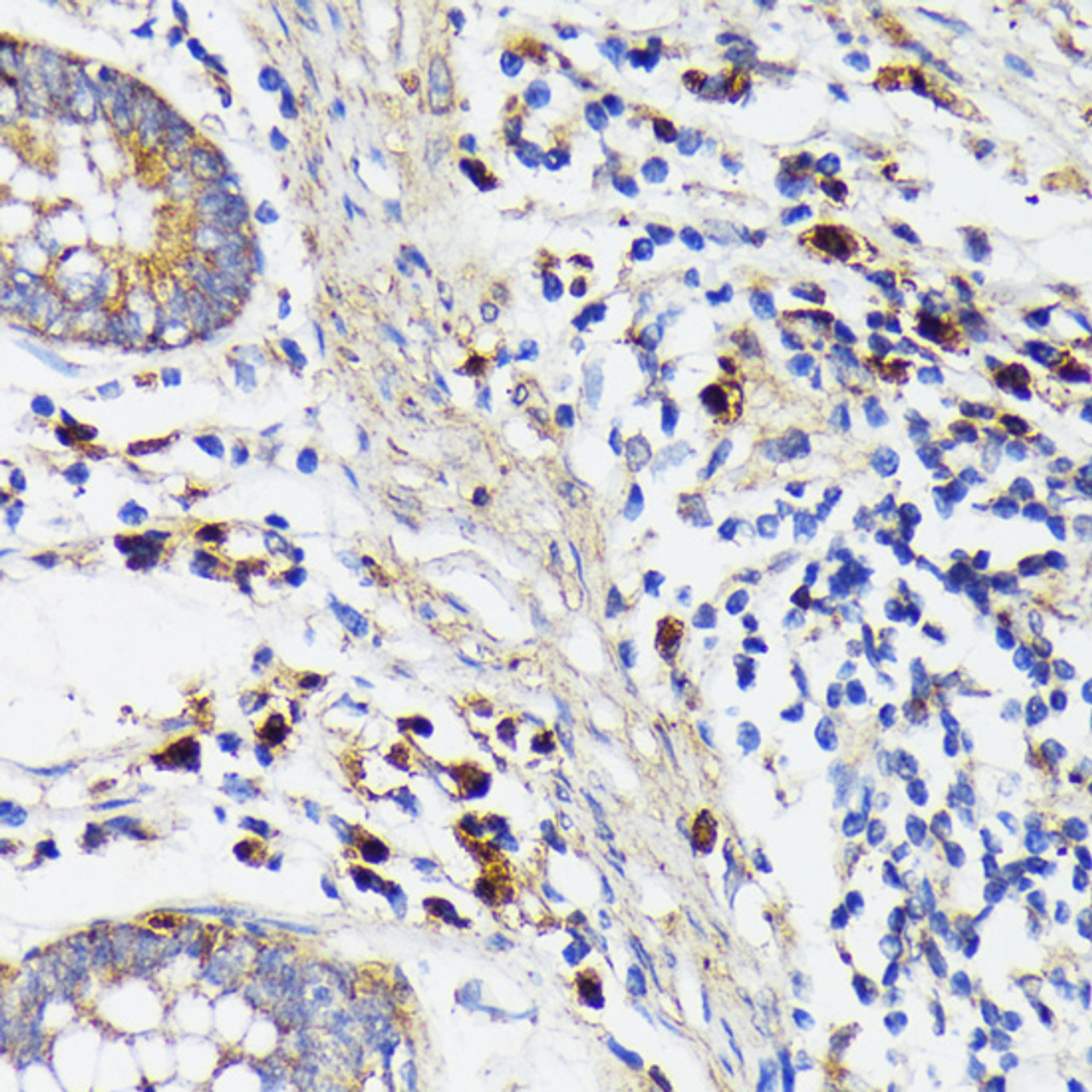 Immunohistochemistry of paraffin-embedded Human colon carcinoma using TREM2 Polyclonal Antibody at dilution of  1:200 (40x lens).