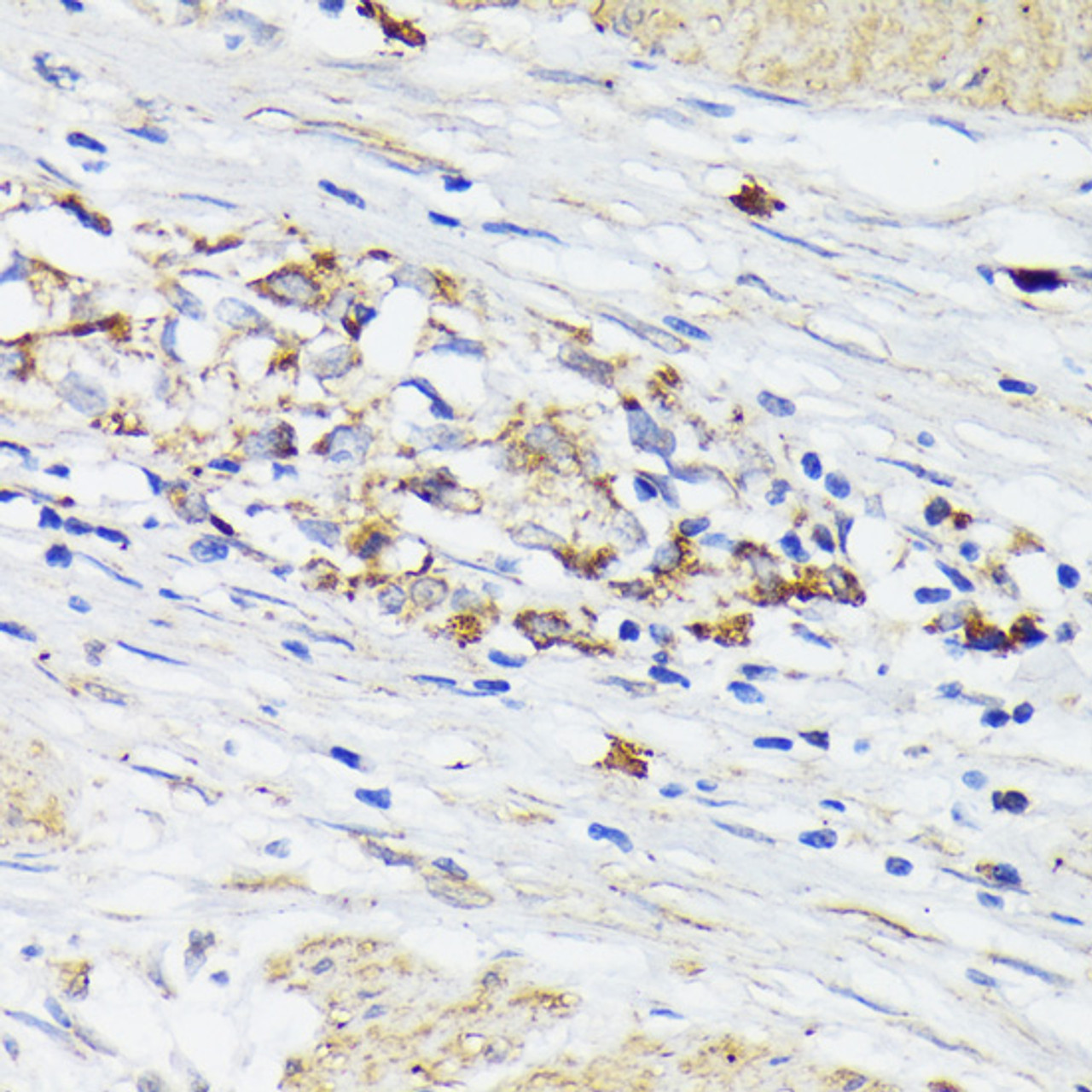 Immunohistochemistry of paraffin-embedded Human gastric cancer using TREM2 Polyclonal Antibody at dilution of  1:200 (40x lens).
