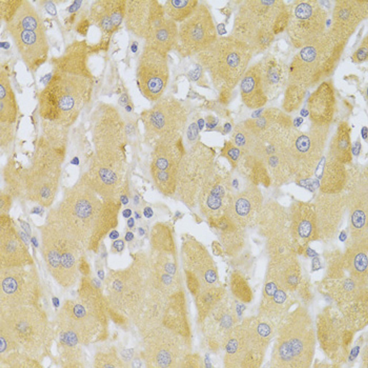 Immunohistochemistry of paraffin-embedded Human liver cancer using Slug Polyclonal Antibody at dilution of  1:100 (40x lens).
